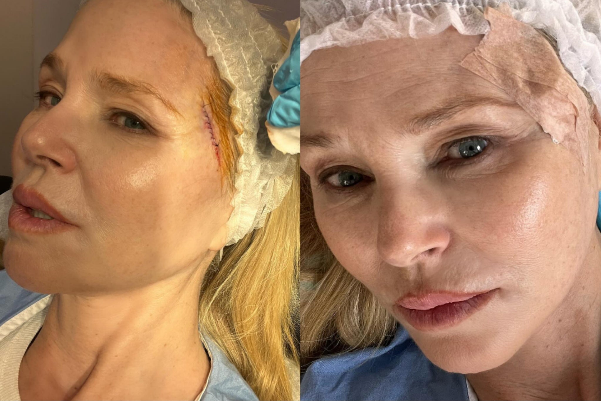 Christie Brinkley shares pictures after cancer cell operation