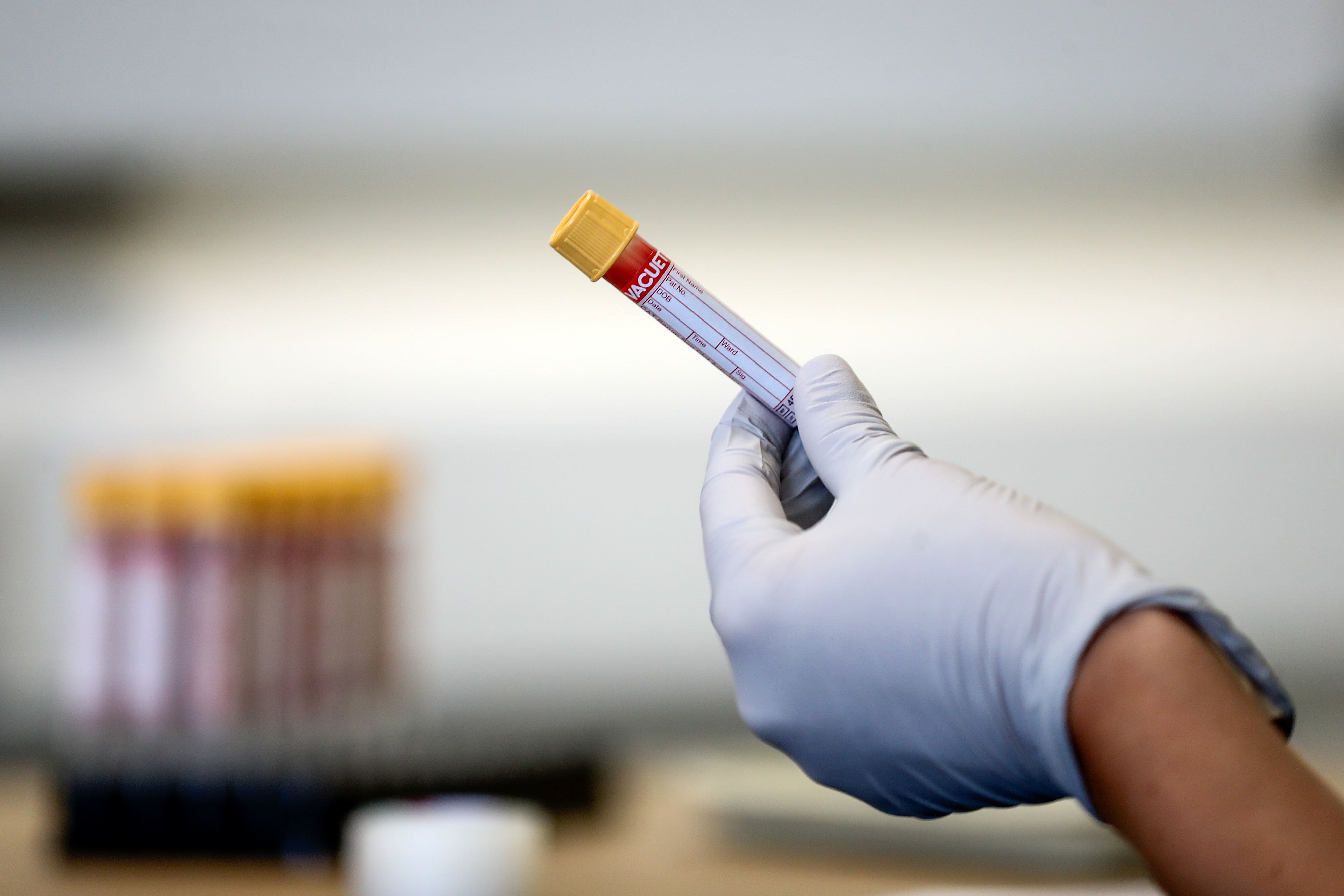 The study used a new technique that identified a set of six proteins that are highly accurate in pinpointing TB (Simon Dawson/PA)