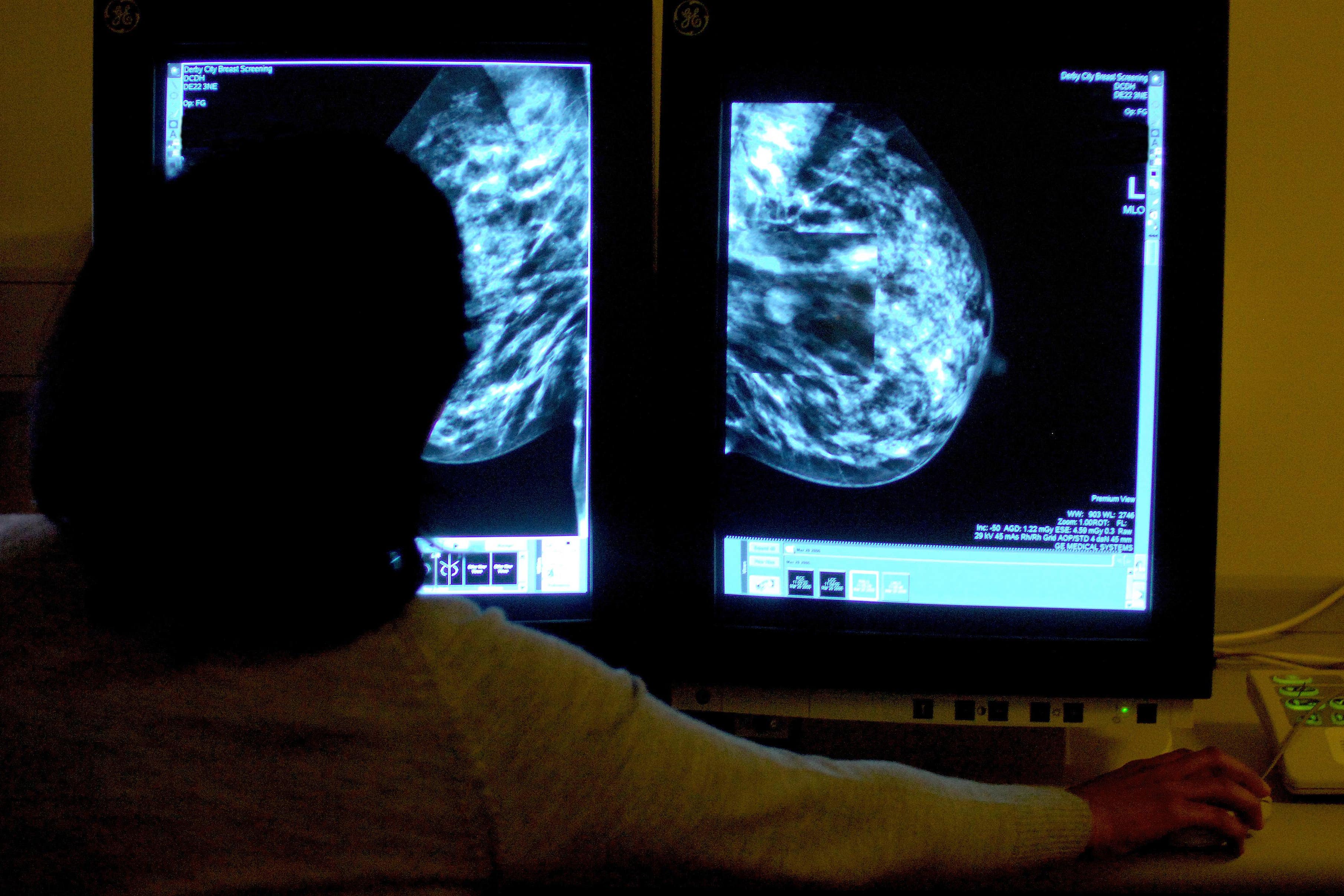 Researchers have made a potential breakthrough on breast cancer (Rui Vieira/PA)