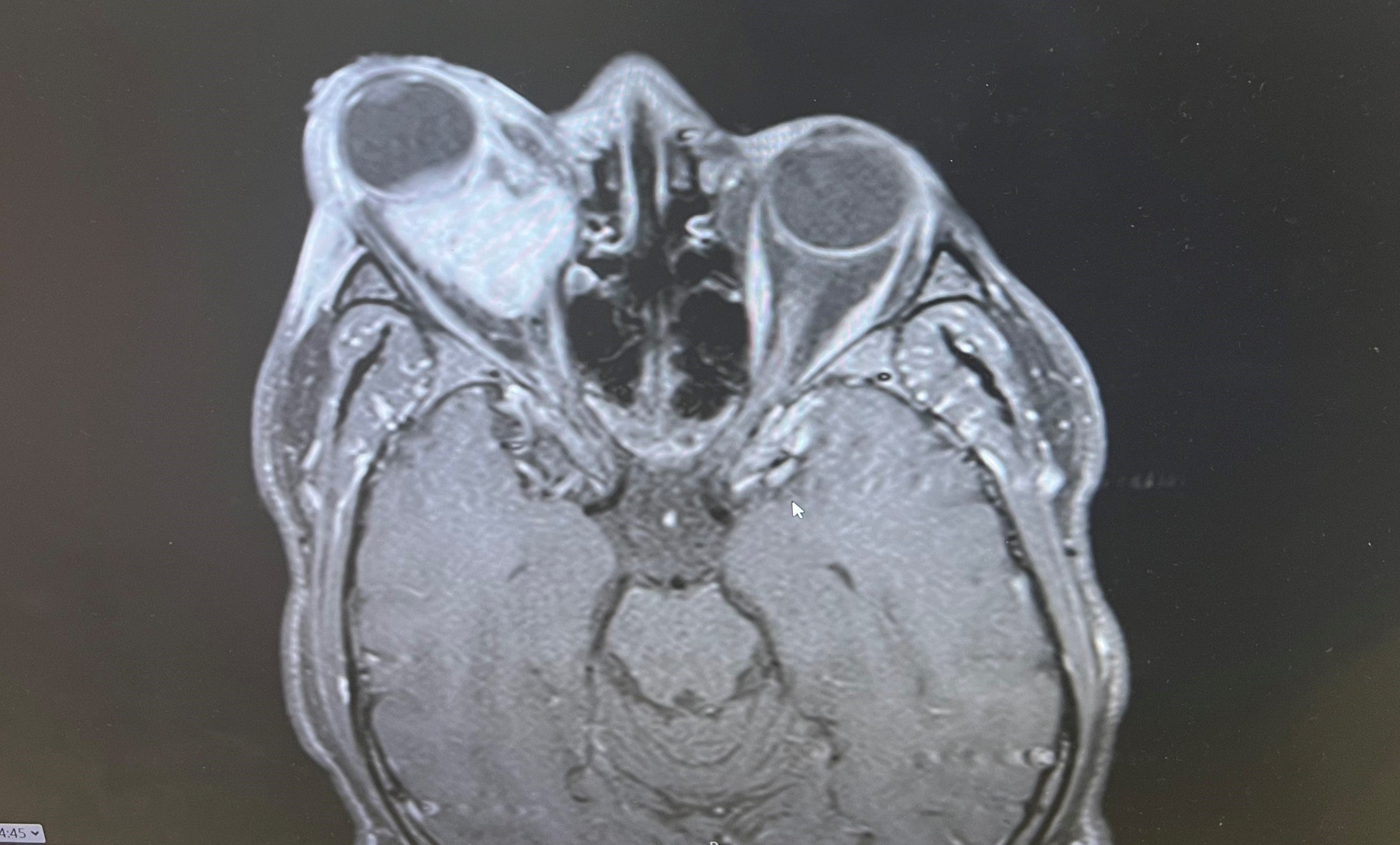 Farid's picture of the scan which shows the tumour (Collect/PA Real Life)