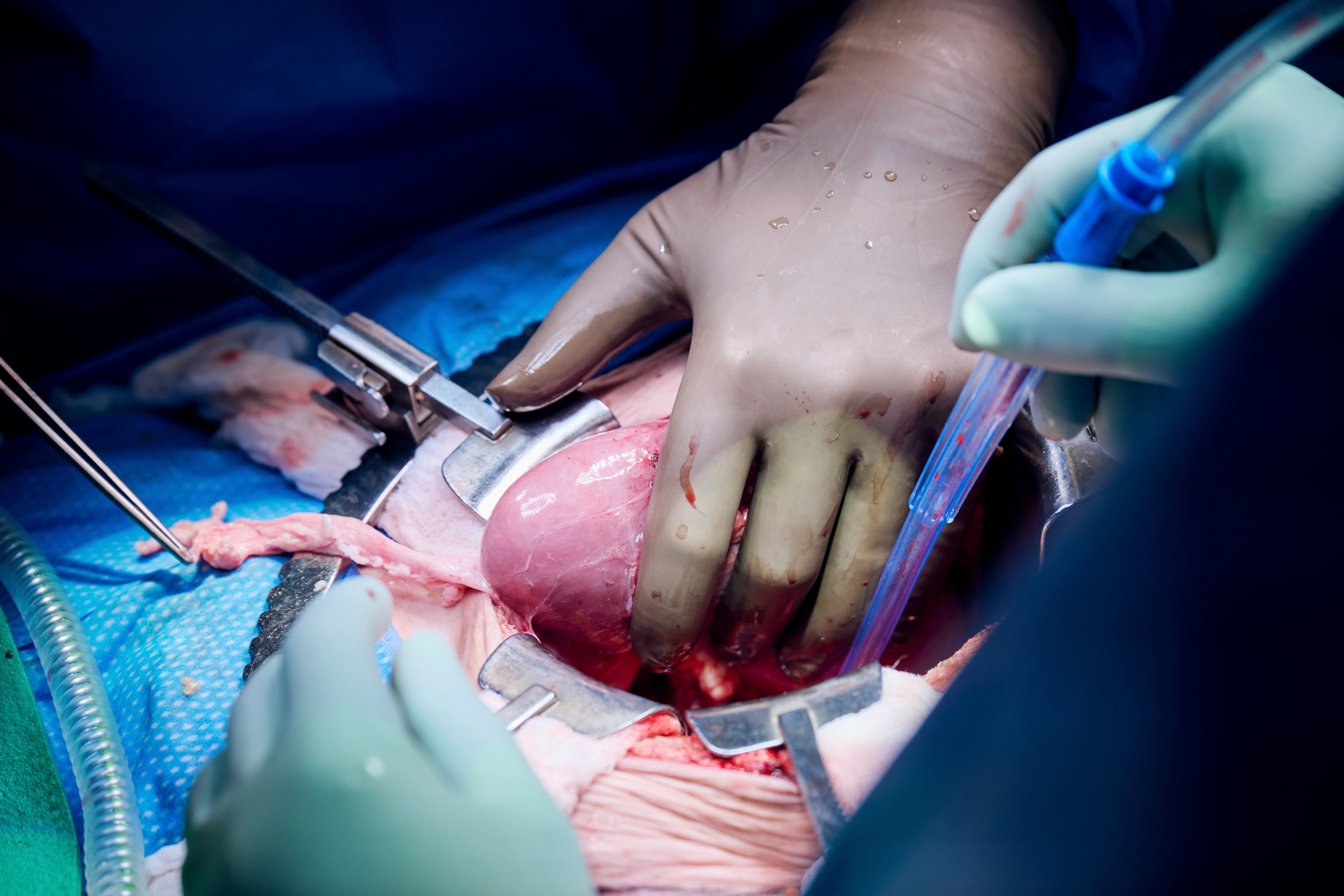 Pig Kidney Transplant