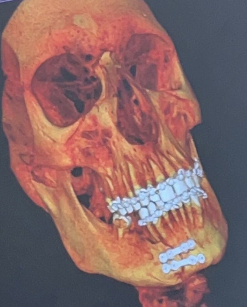 A scan showing Callum's skull after being treated at Broomfield Hospital in Chelmsford (Collect/PA Real Life)