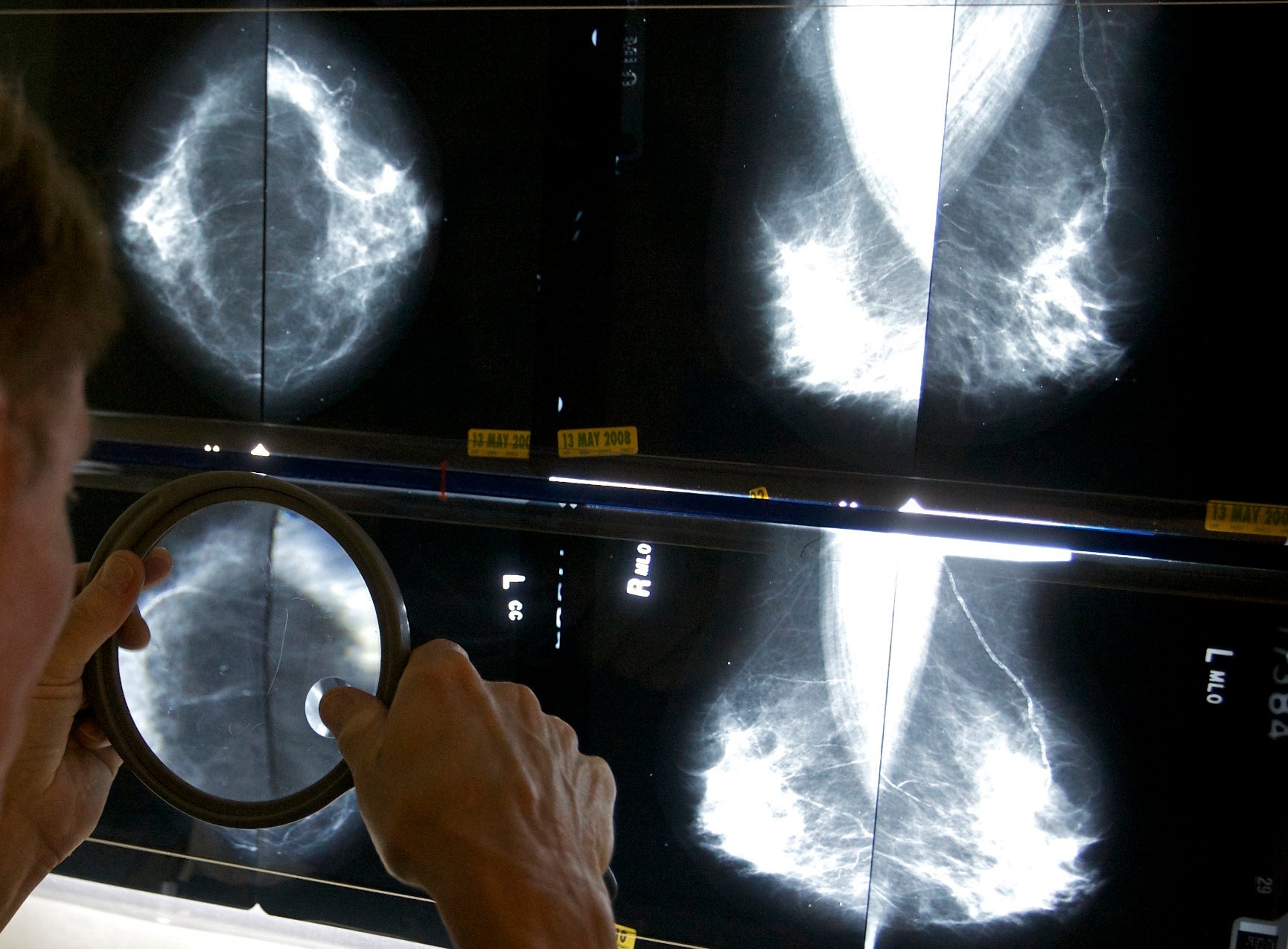 A radiologist uses a magnifying glass to check mammograms for breast cancer