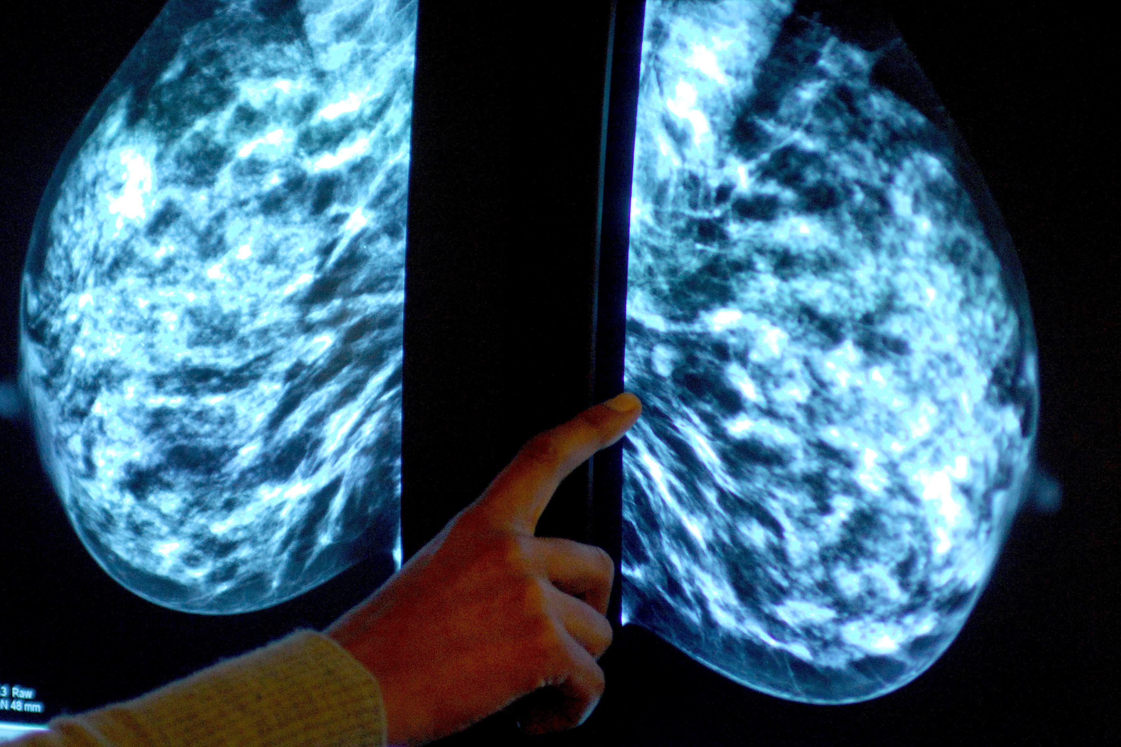 A new study has enabled scientists to study breast tissue in detail outside the body (Rui Vieira/PA)