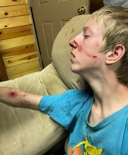 Fifteen-year-old Brigham Hawkins was attacked by a bear while camping with his family last week in Arizona