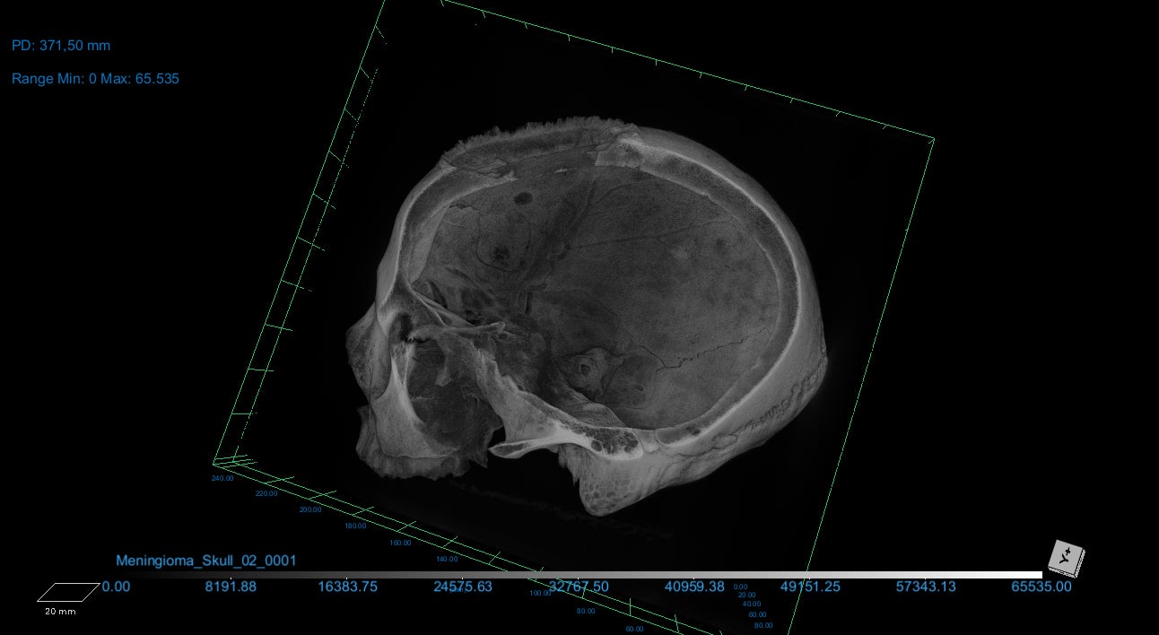 Researchers have found evidence of cutmarks on a skull around a large lesion thought to have been caused by a cancerous growth