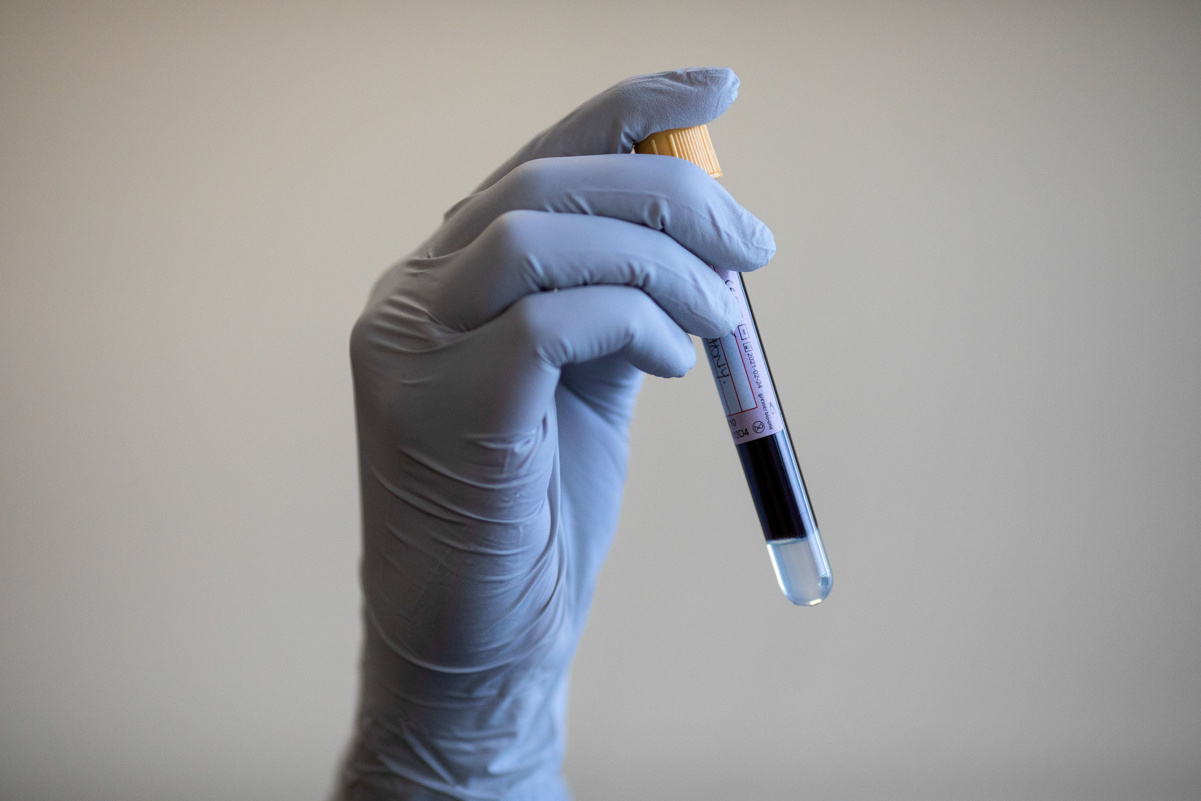 A blood test can reveal the presence of prostate cancer