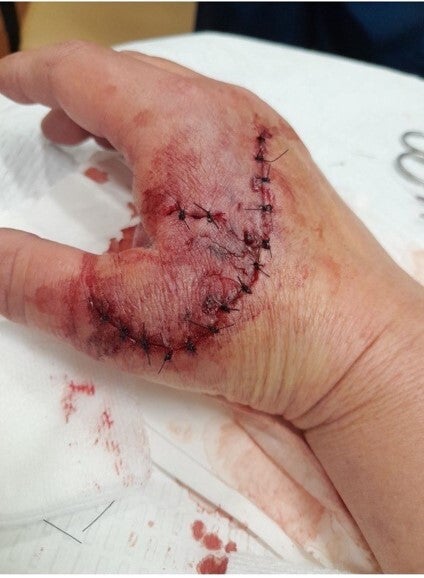 A mixed-breed shepherd attacked Snyder, leaving her needing 16 stitches (pictured)