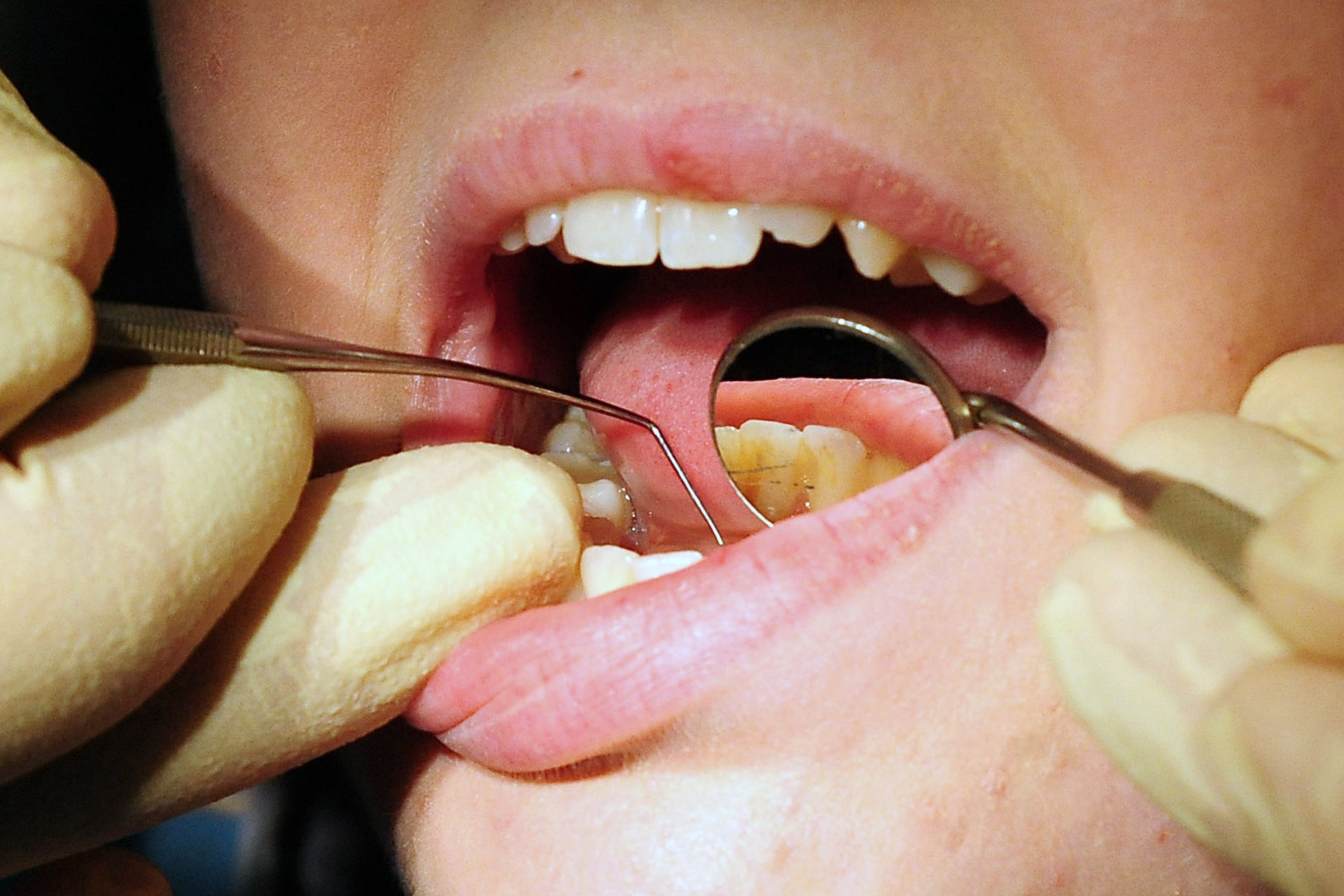 Green party co-leader Adrian Ramsay said it was a ‘national outrage’ that children were being admitted to hospital for tooth decay, as thousands struggle to access dental care (PA)