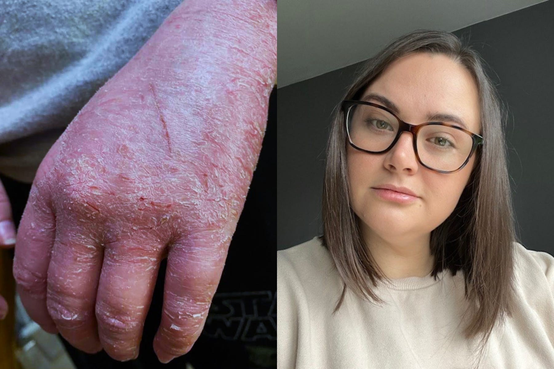 Robyn Brain said she thought she would have the painful psoriasis ‘forever’ until she discovered a ‘magic cream’ (Collect/PA Real Life)