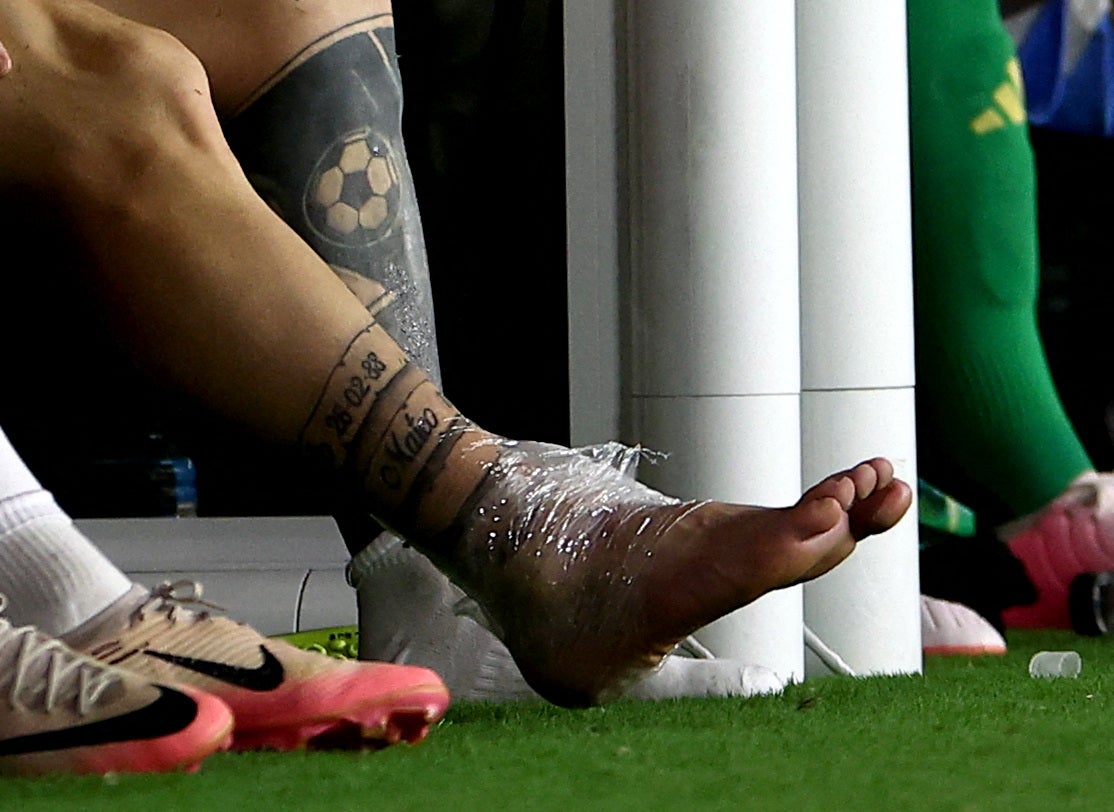 Messi’s ankle was swollen and wrapped in ice