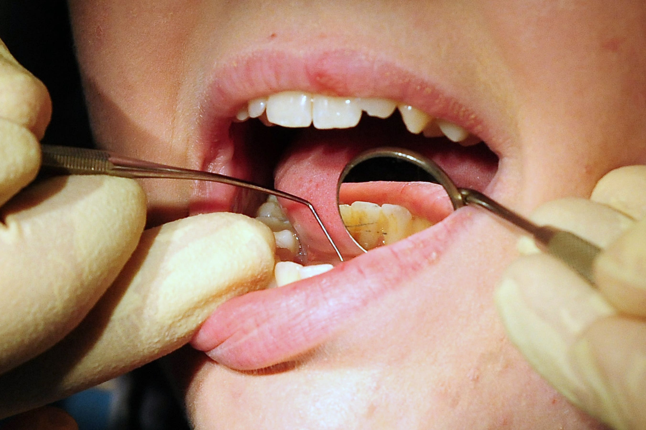 Researchers said there was an urgent need for fairer access to dental services to tackle inequalities (Rui Vieira/PA)