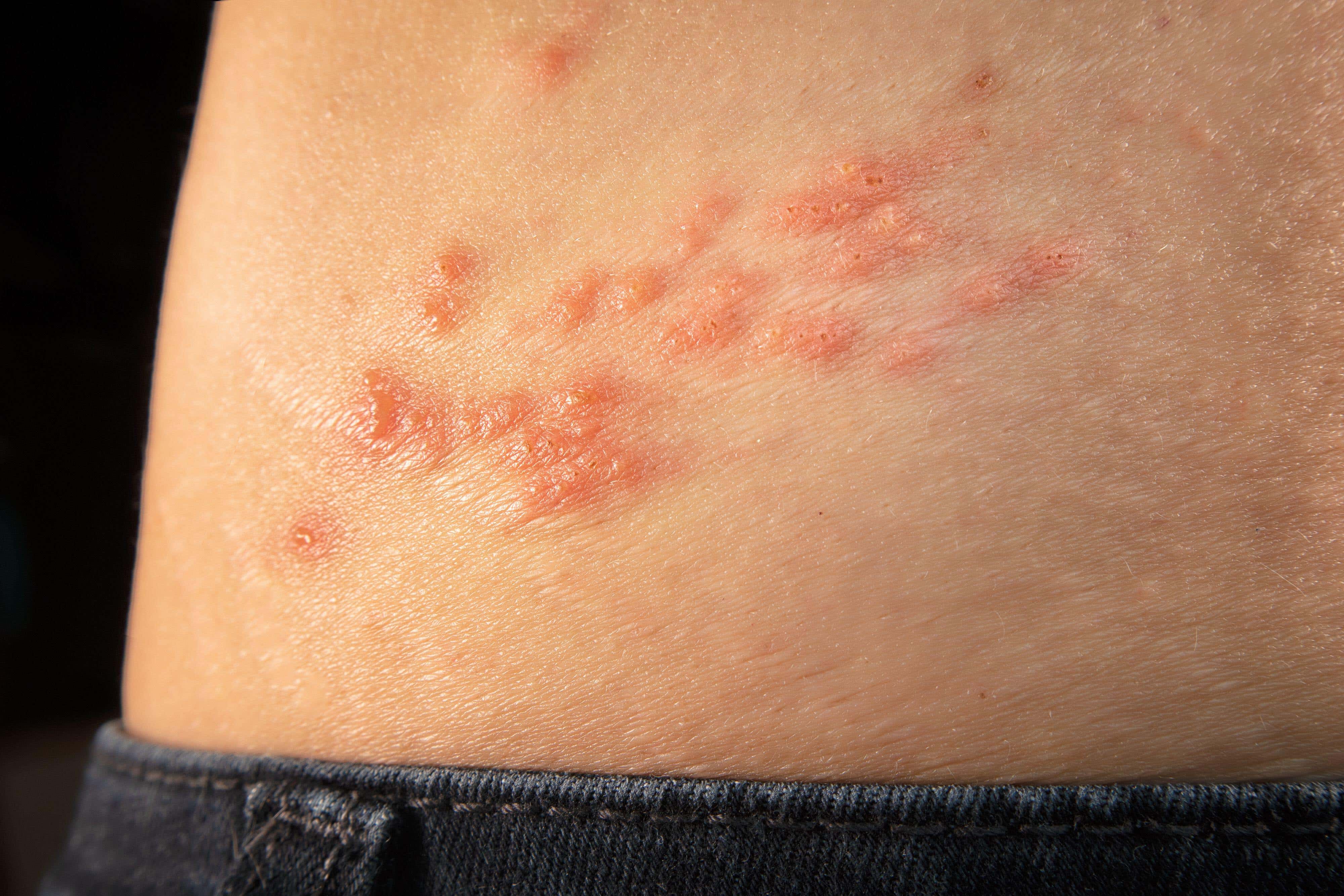 Shingles causes clusters of small, fluid-filled blisters known as vesicles