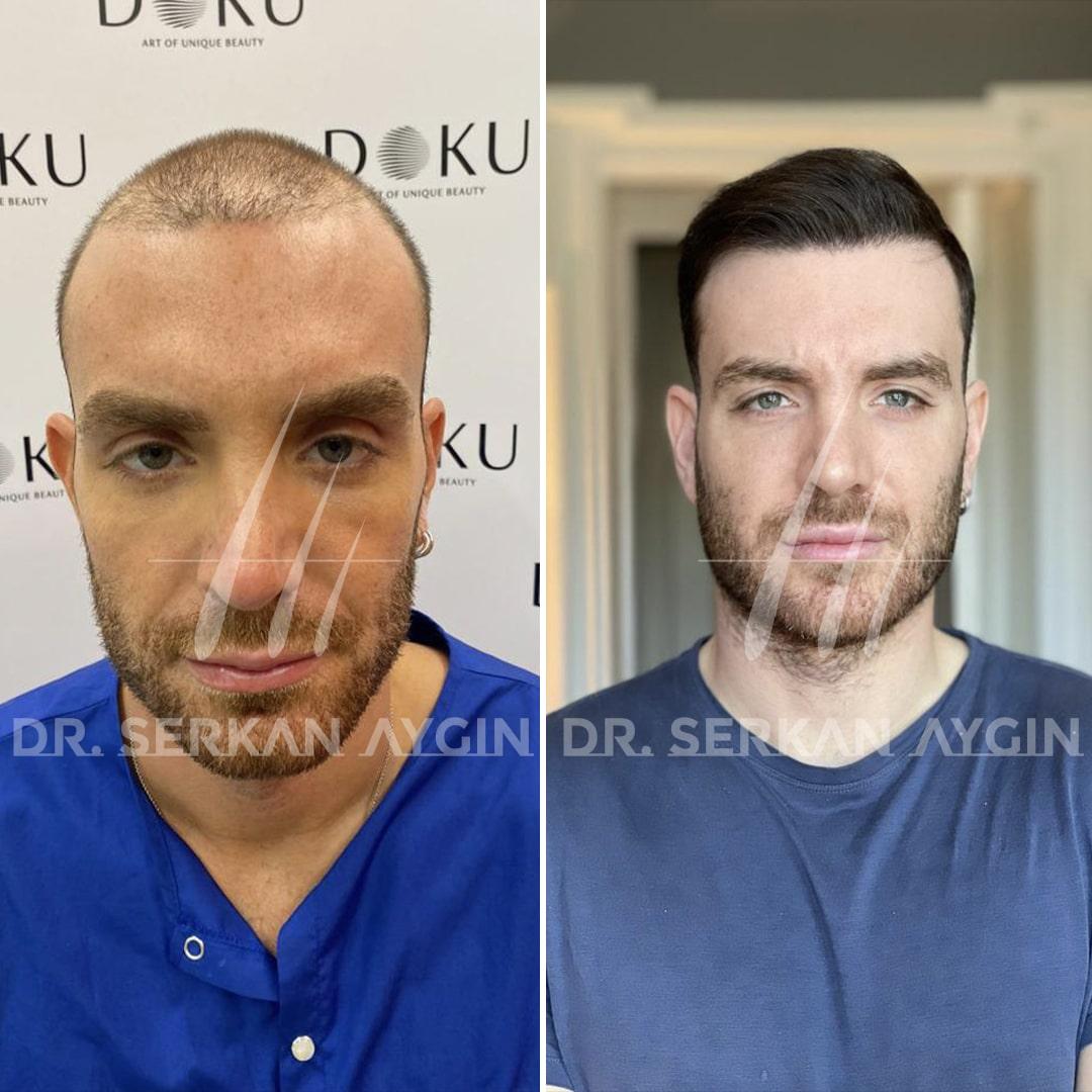 Transforming Confidence: Witness the stunning hair restoration results at Dr. Serkan Aygin Clinic