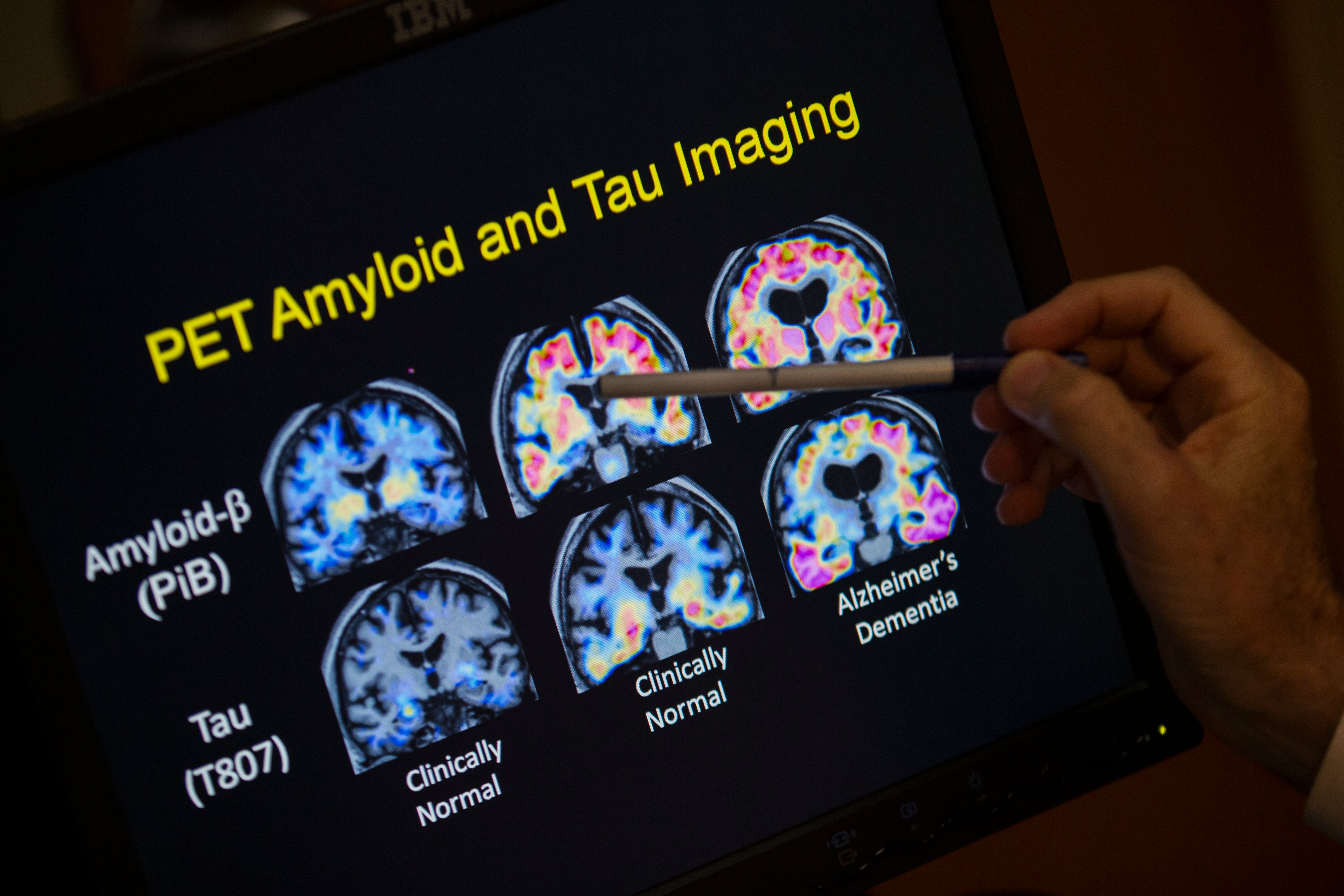 Be Well-Alzheimer’s-Blood Tests