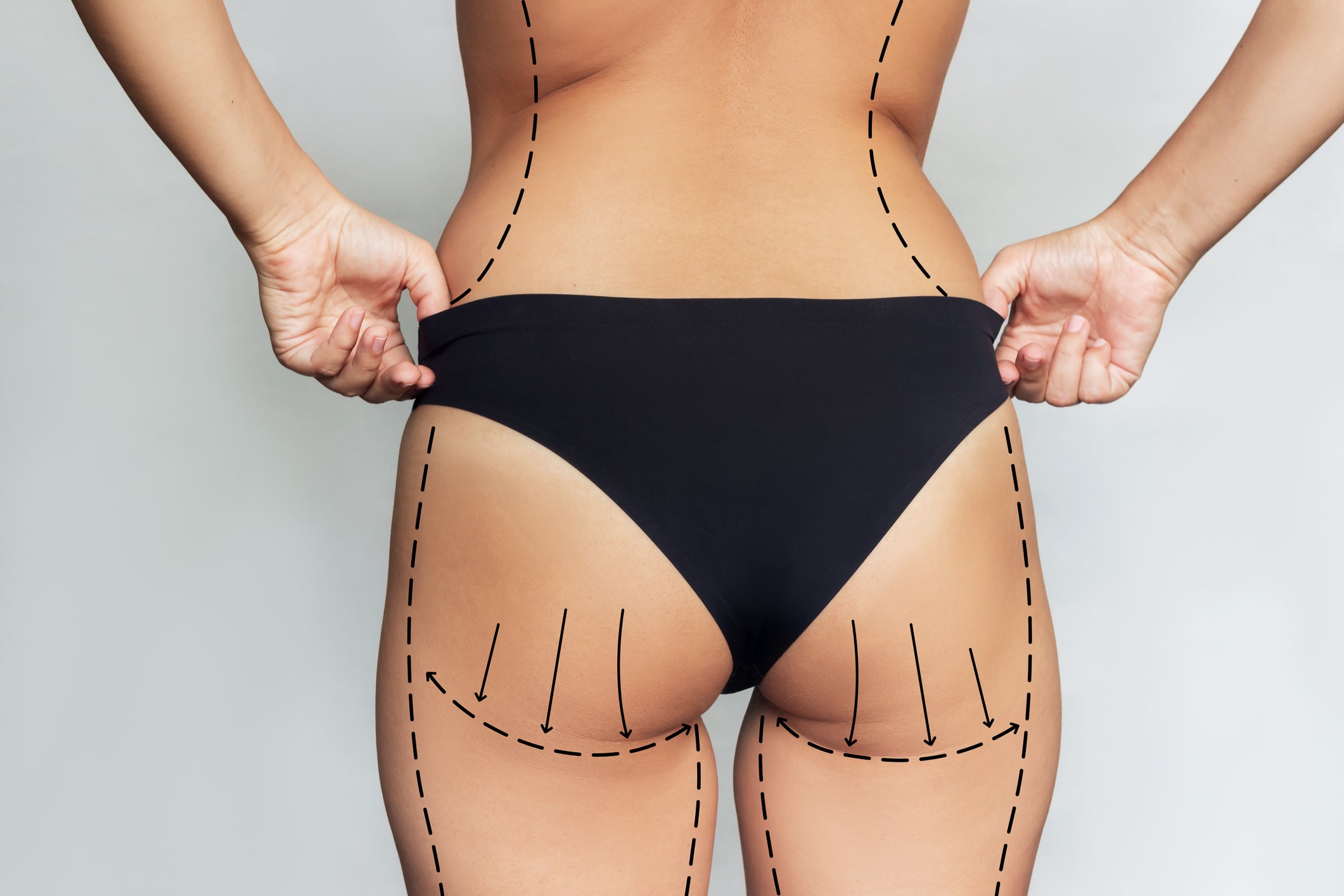 Of the total 507 complaints, 479 involved Brazilian bum lifts (BBL) and hip dips