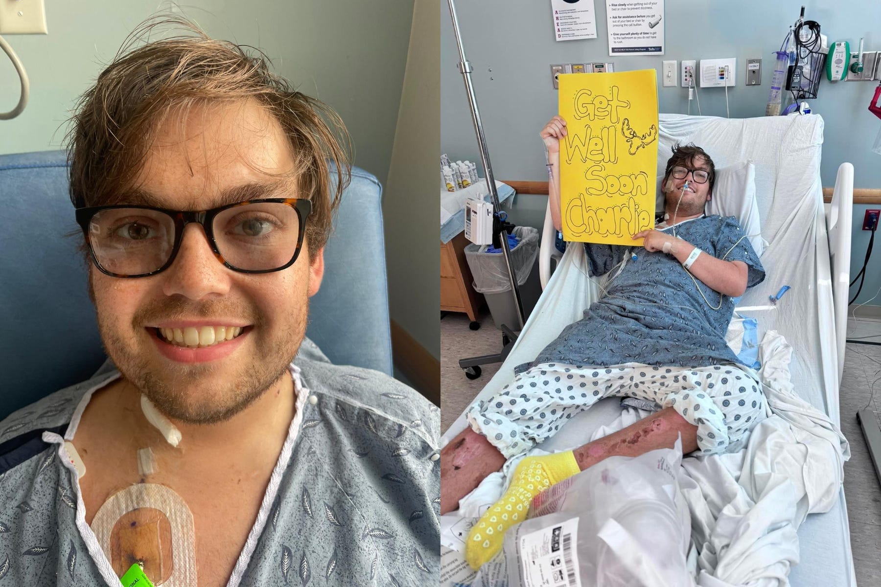 University student Charlie Vincent was working at a summer camp in America when he was taken to hospital after becoming badly sunburnt (Collect/PA Real Life)