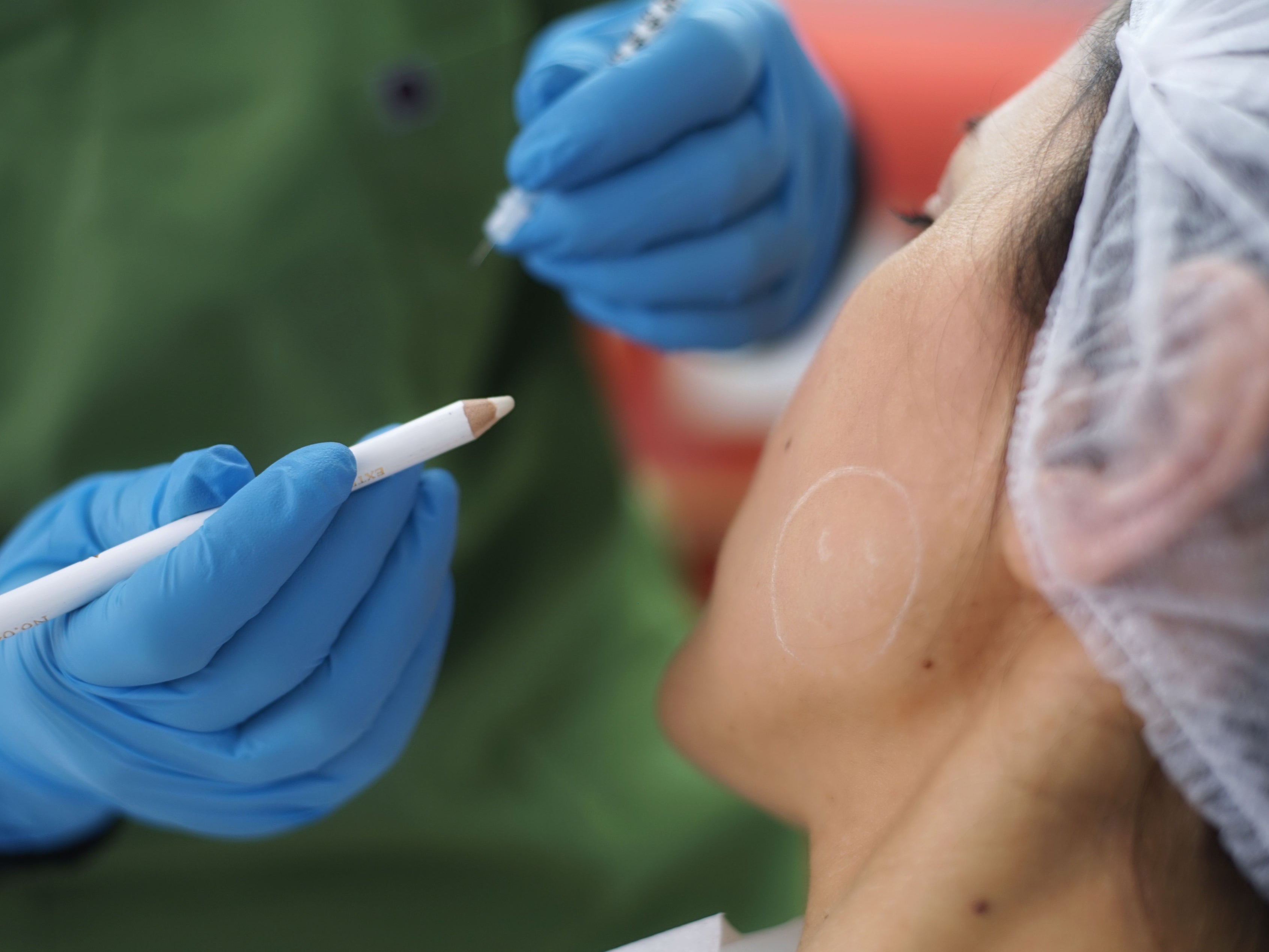 Nejběžnějšími vedlejšími účinky, které lidé zažívají, jsou některé počáteční modřiny a otoky
