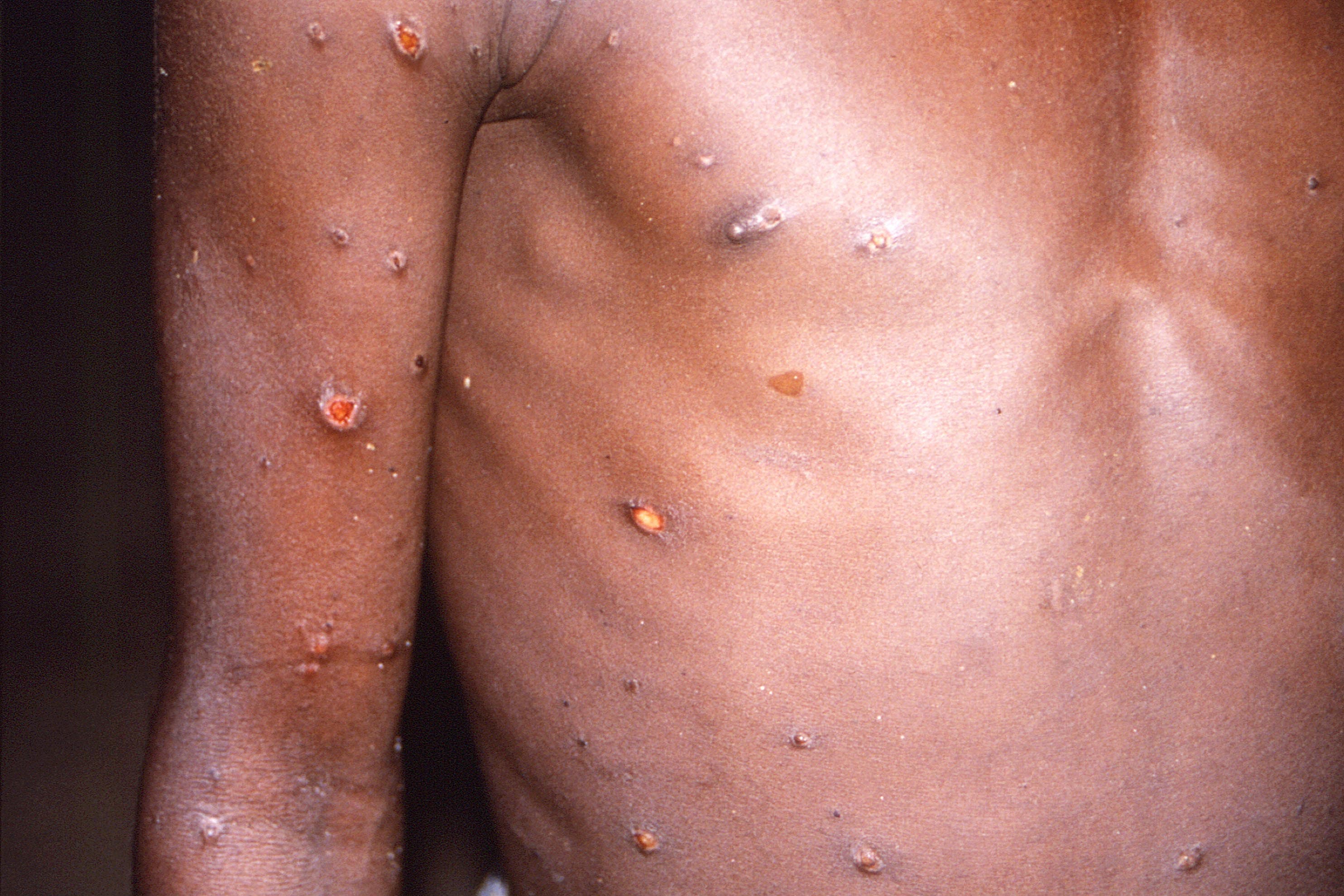 A new strain of mpox has been reported in parts of Africa (PA)