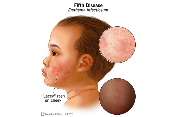 The CDC is warning that parvovirus - commonly referred to as “slapped cheek” - infections are rising in children aged 5 to 9 years old