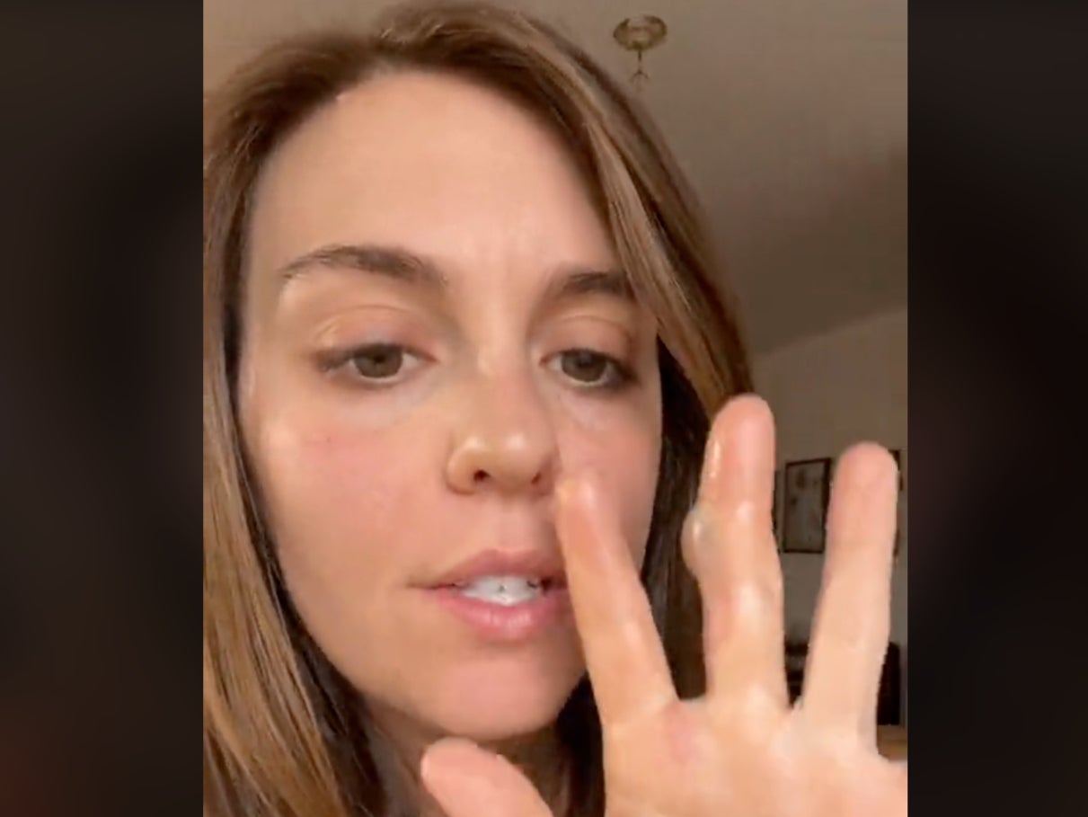 TikTok user @bethanybreanne shows off a second-degree burn on her finger she received while attempting to make “candy grapes.” The recipe to make the candy has gone viral on TikTok and requires users to melt candy. The molten candy has caused severe burns to several adults and children attempting the trend