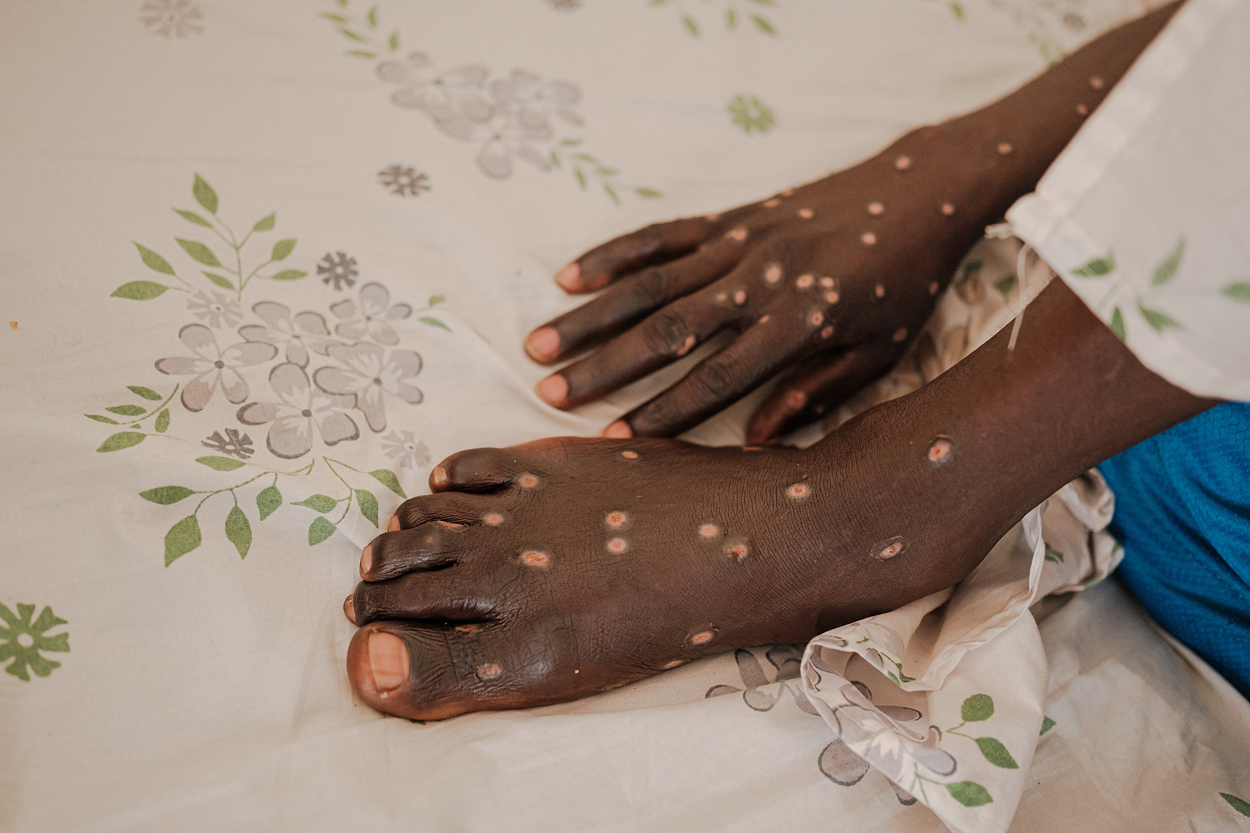 A man infected with Mpox lies on a bed inside a ward at the Kamenge University Hospital's Mpox treatment center in Bujumbura