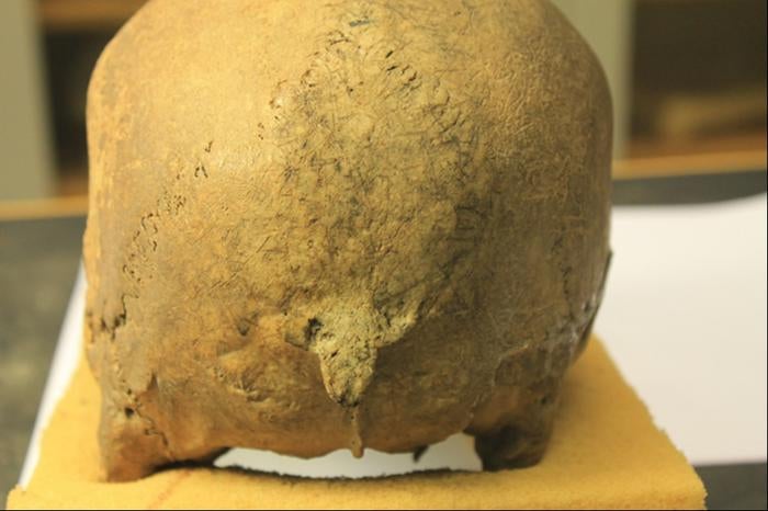 Damage seen on remodelled Viking skull bone