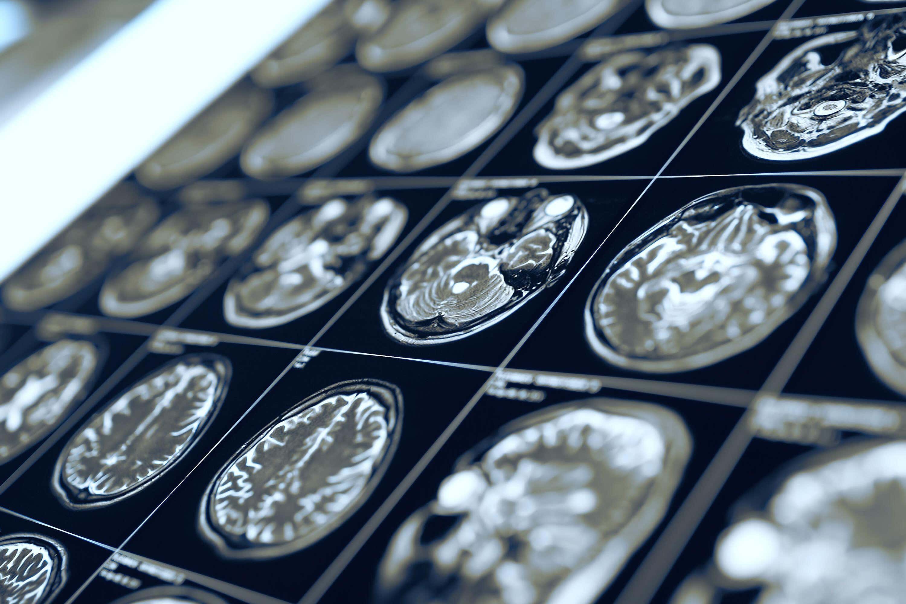 The team scanned the brains of 30 patients with Covid-19 who had been admitted to hospital with Covid-19 during the pandemic