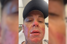 Slipknot’s Sid Wilson says ‘face is basically melted’ after bonfire explosion