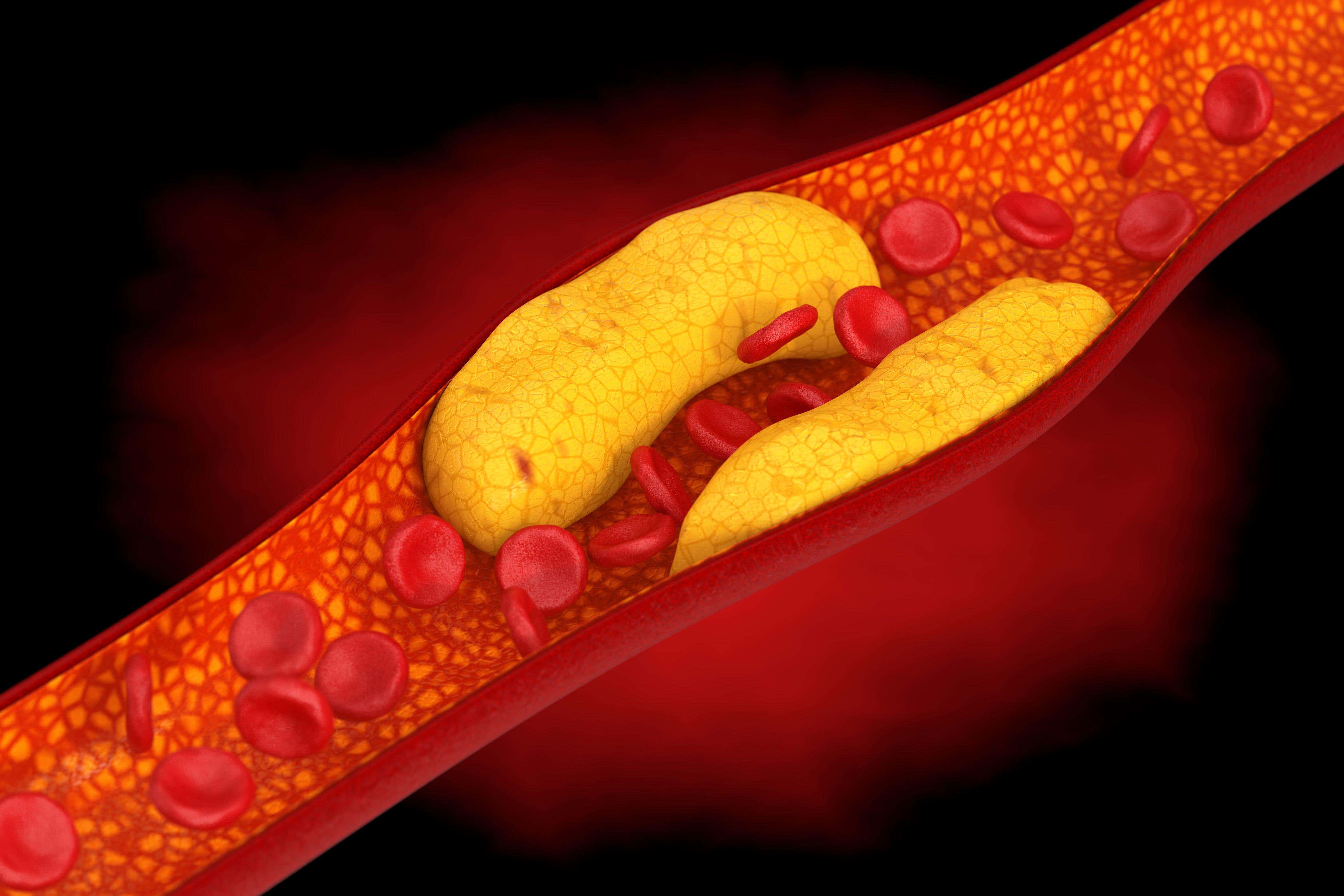 An artery blocked with cholesterol