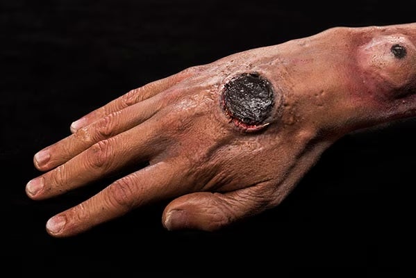 A sore from an anthrax infection is seen on a man’s hand. Symptoms in humans usually begin between one day and a week after exposure, and depend on how anthrax enters the body.