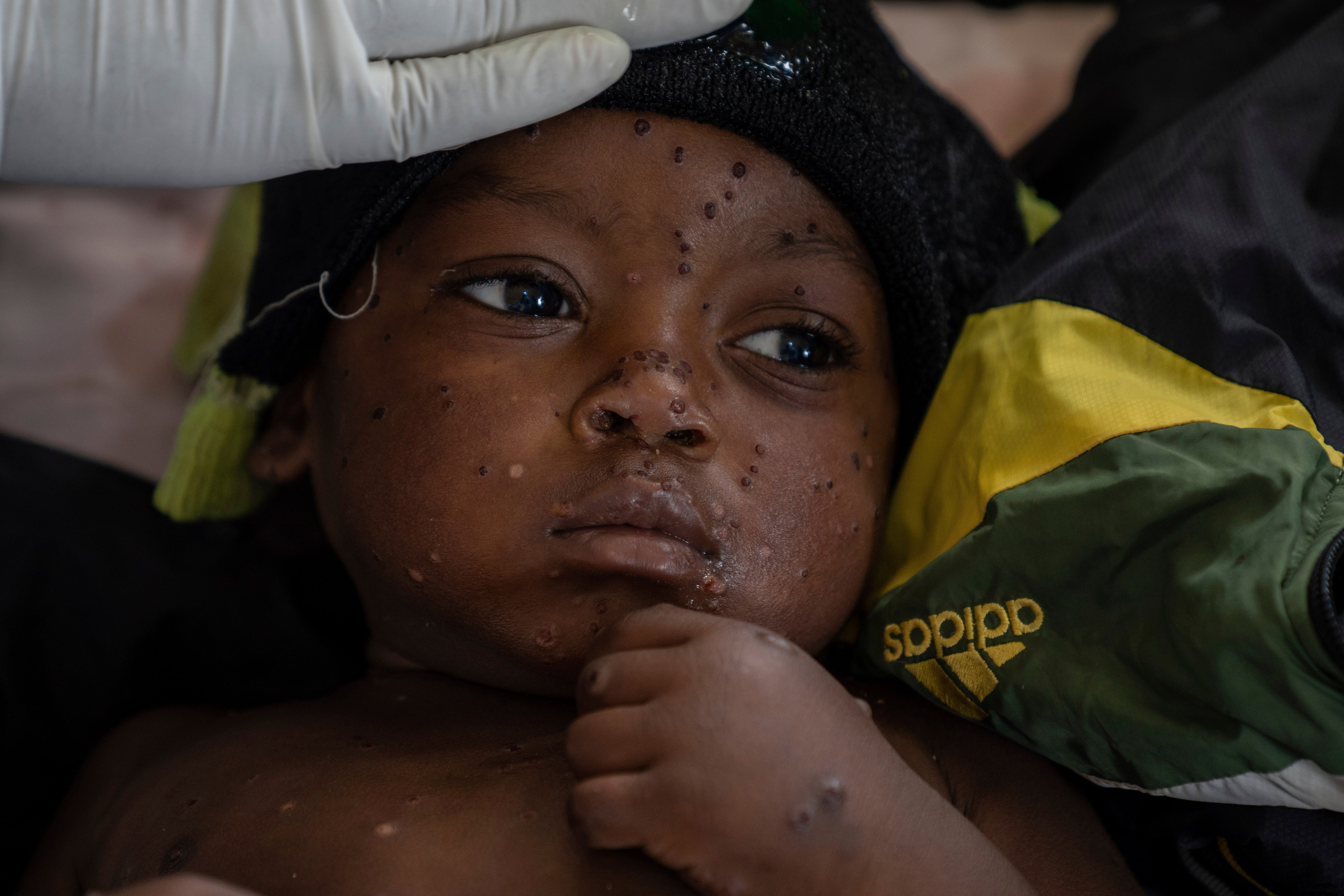 Congo Mpox Outbreak Epicenter