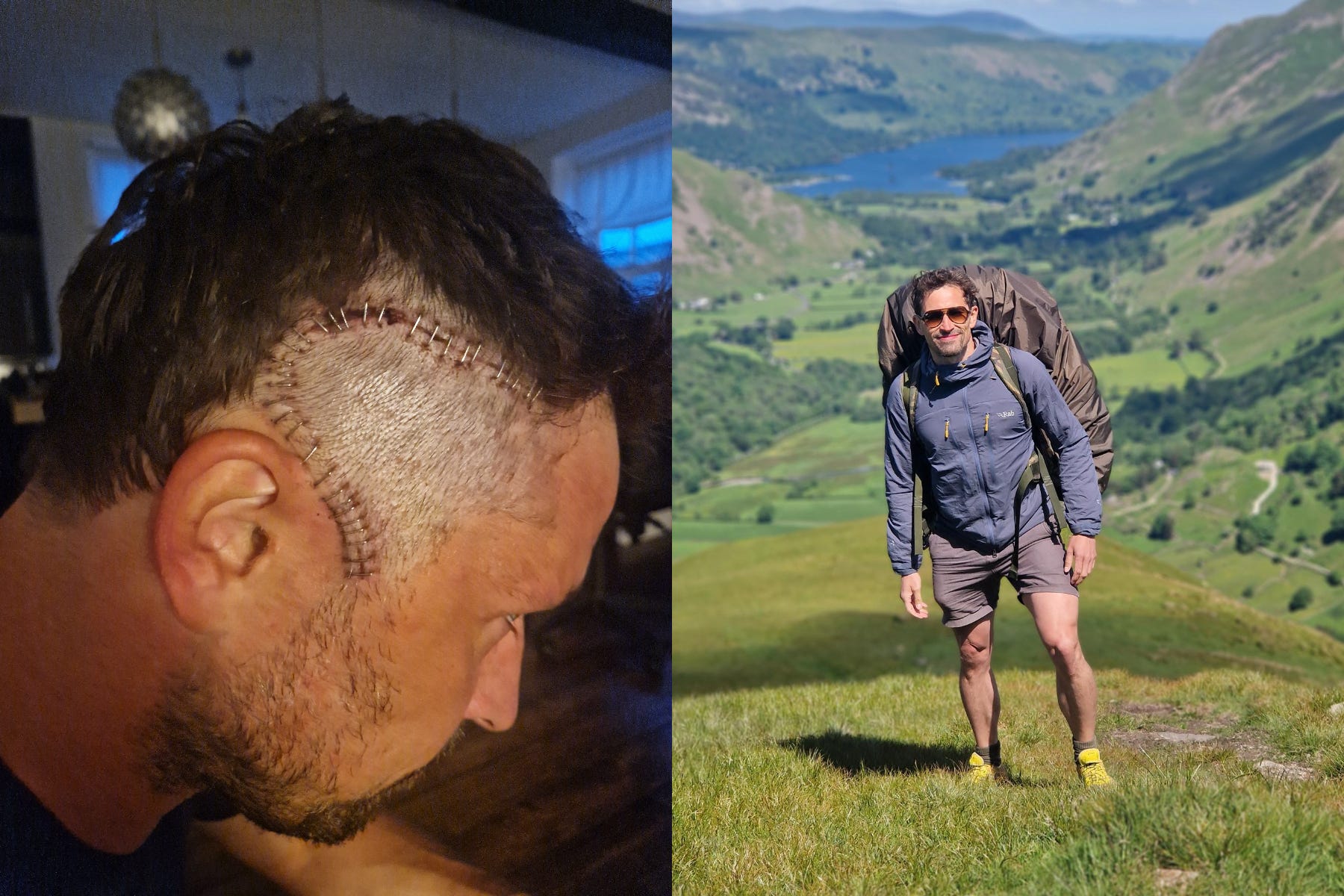 A split image of James on the left with a scar on his head and a picture of James standing in a field carrying a backpack on the right