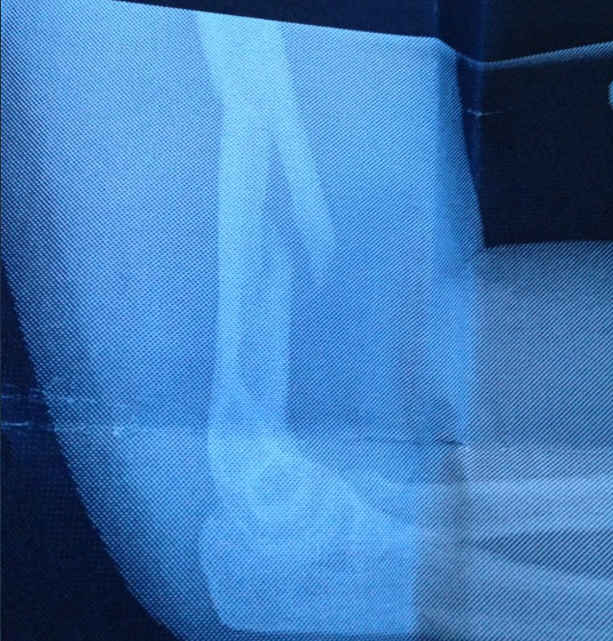 X-ray image of Newcombe’s broken arm in 2014 while he was at Bostall House