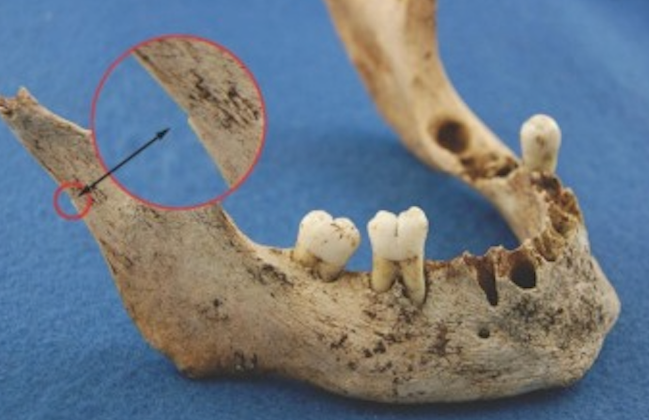 Mandible showing modification consistent with cannibalism