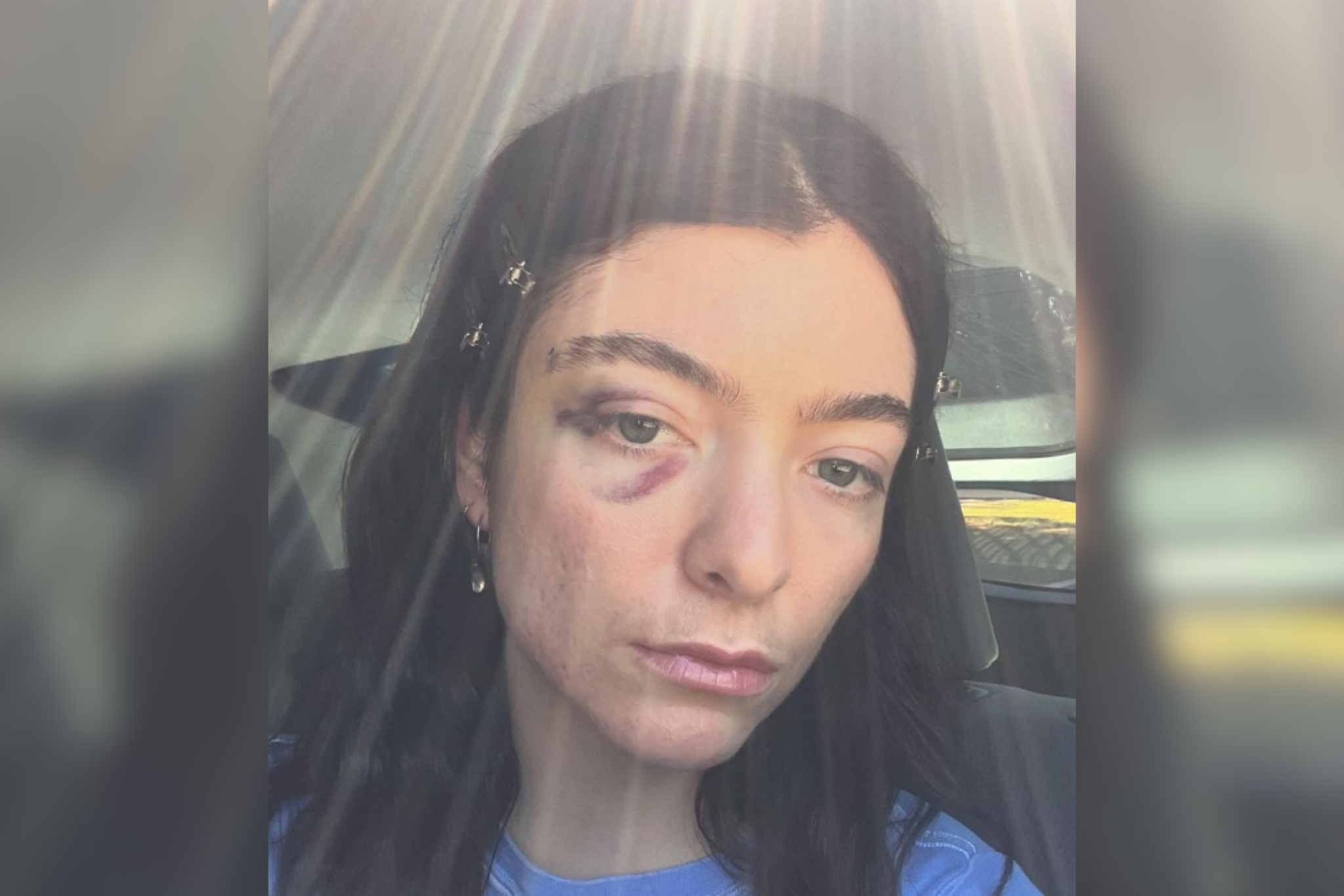 Lorde sports a black eye in her latest Instagram post