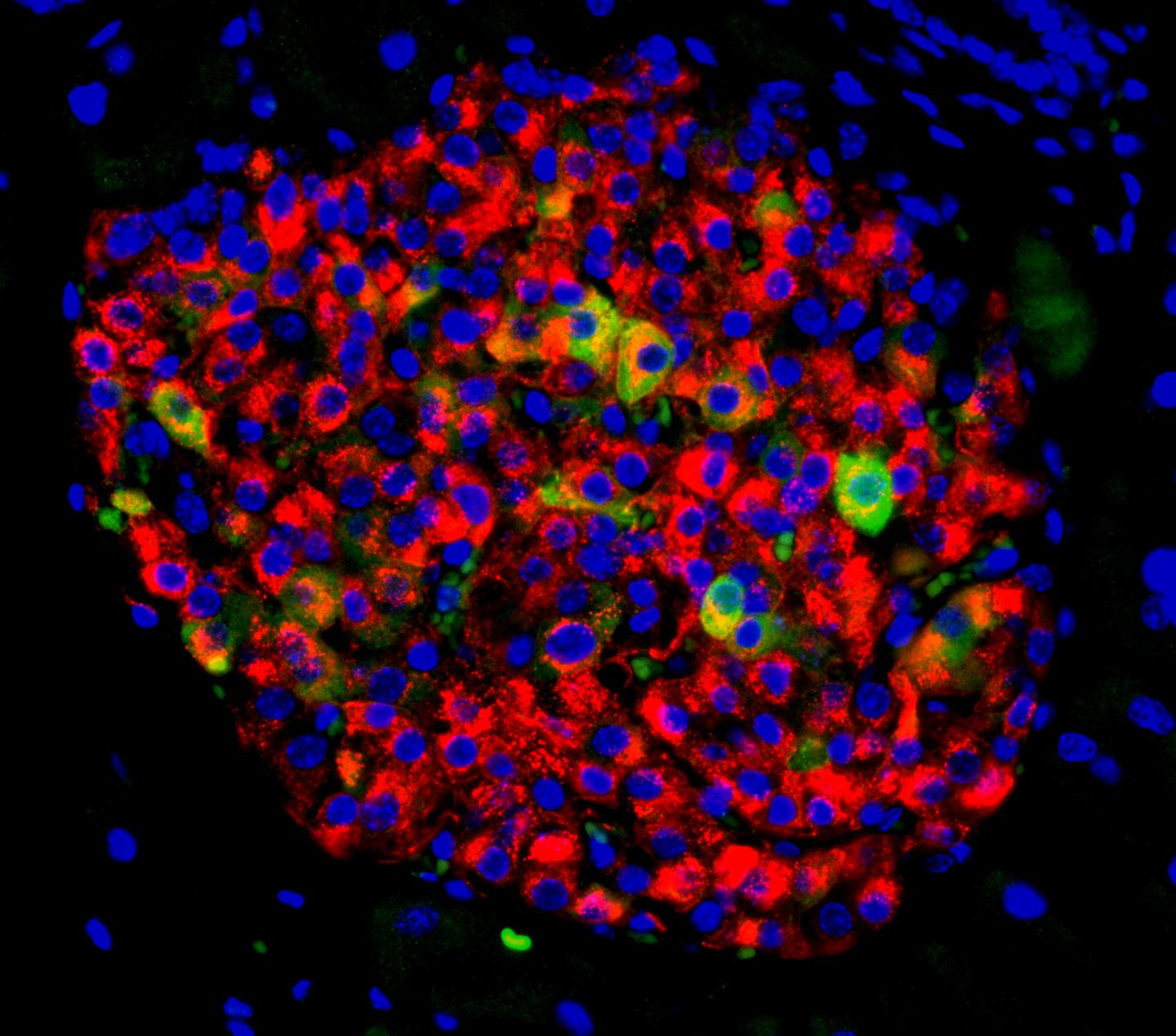 Pancreatic islet with insulin-producing beta cells (in red) and beta cells showing signs of failure (in yellow and green)