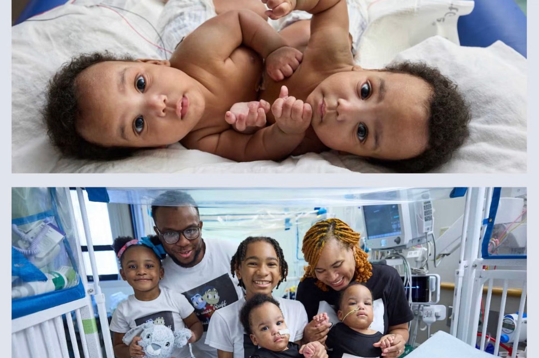 Amari and Javar Ruffin were separated at the Children’s Hospital of Philadelphia in August after spending 10 months attached at the abdomen