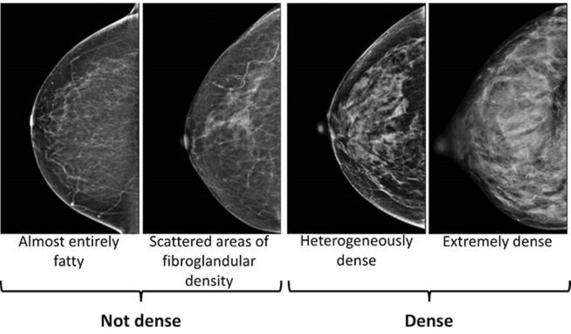 Be Well-Dense Breasts