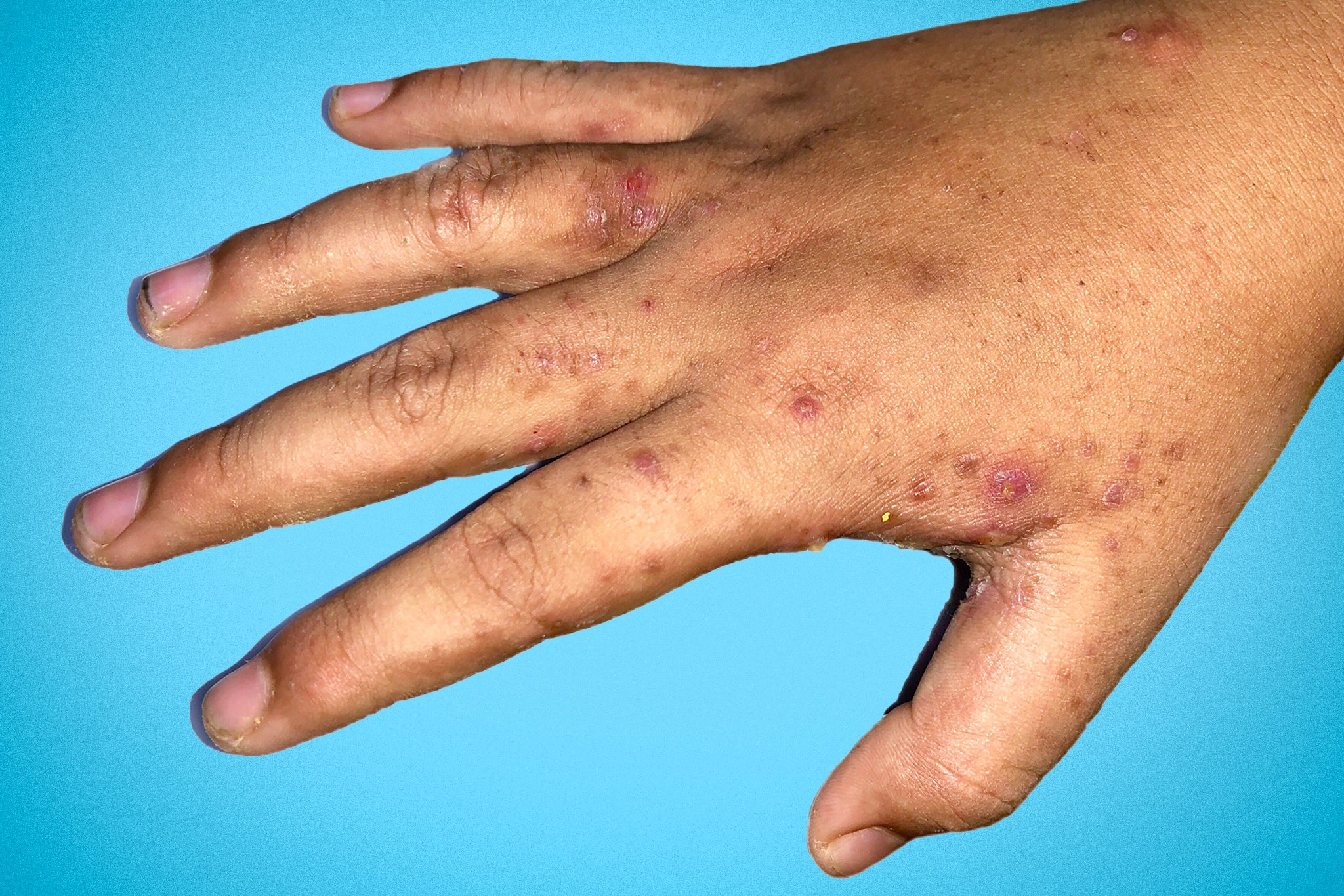 Scabies causes an intensely itchy skin rash caused by mites burrowing under the skin and laying eggs