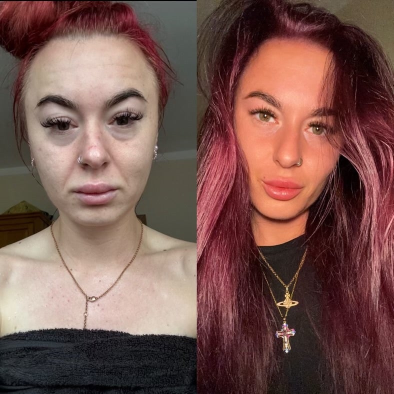 Casey Innalls now, and before she wrecked her health with ketamine