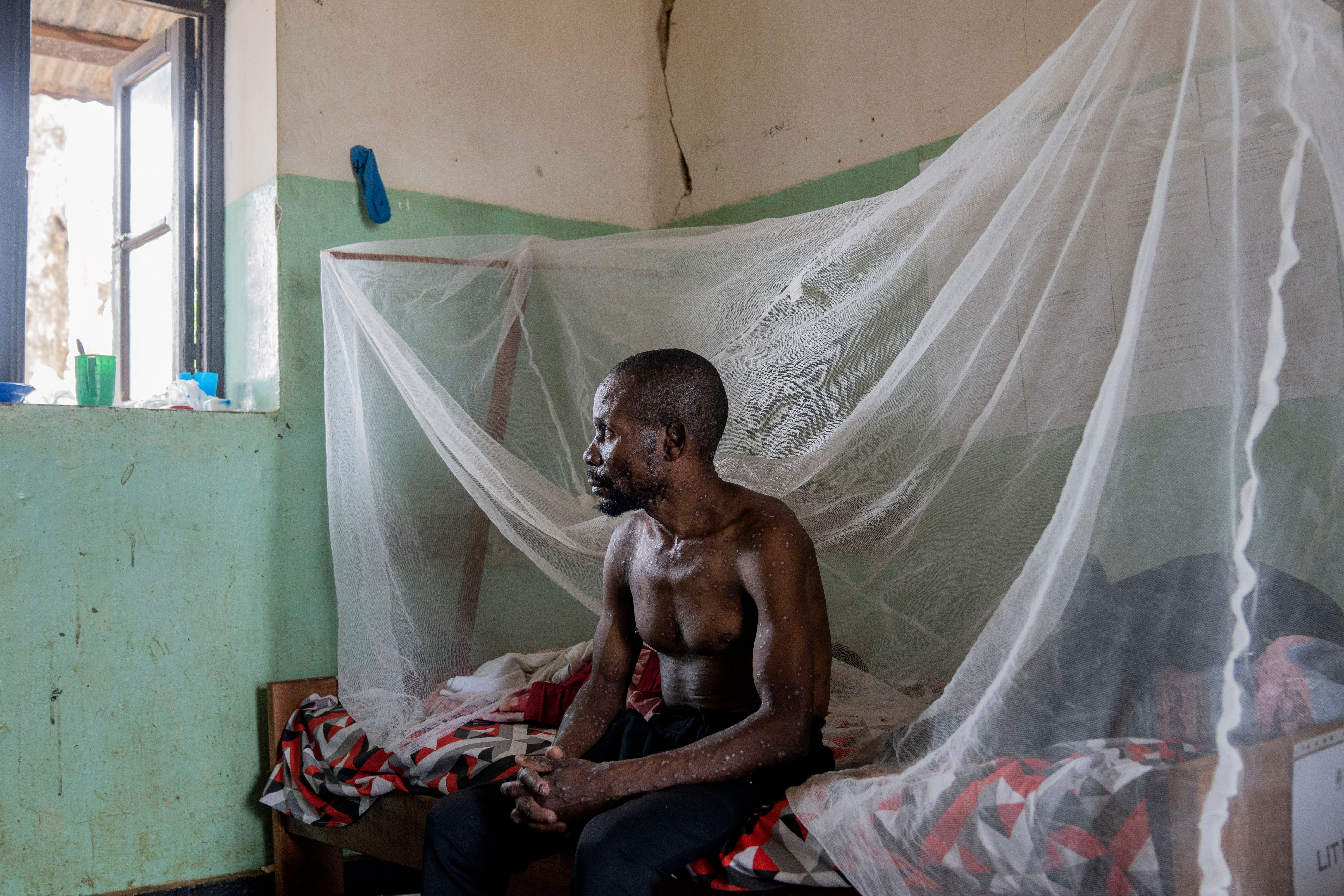 A man suffering from mpox poses for a photograph as he waits for treatment at the Kamituga General Hospital in South Kivu Congo