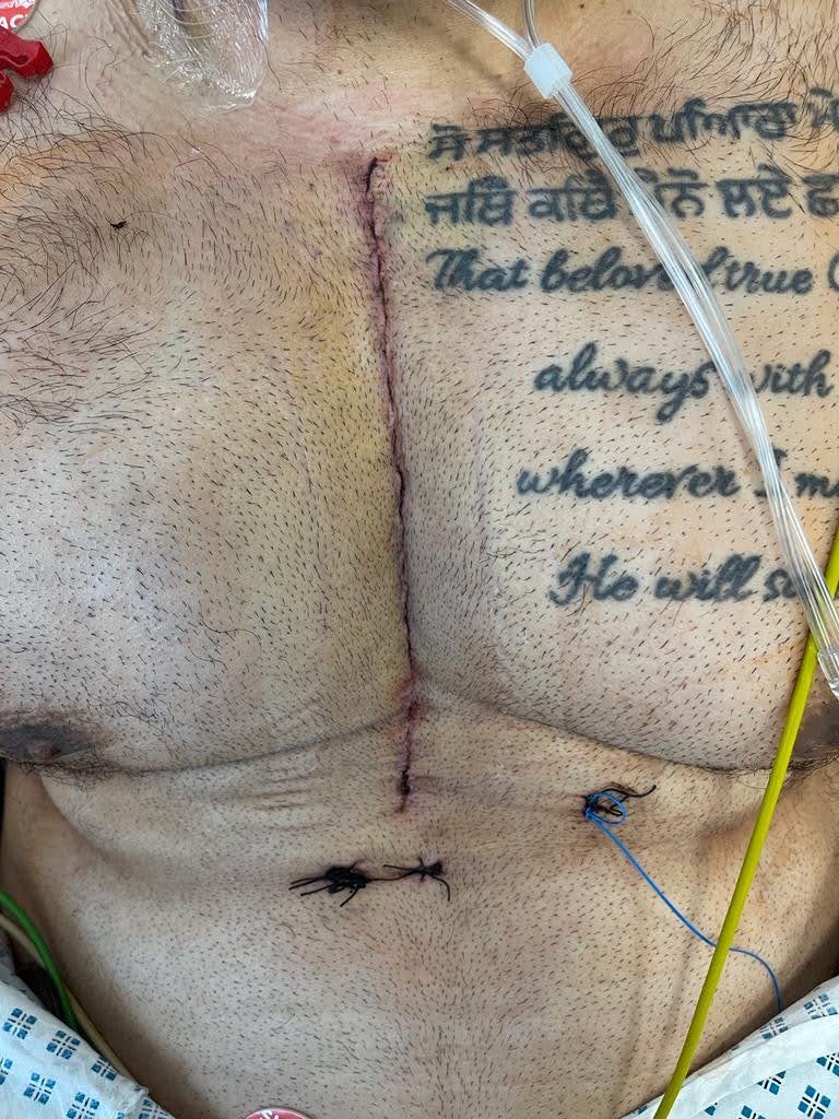 Simarjot’s scar from the quintuple heart bypass surger