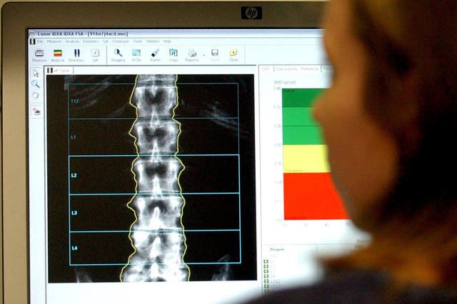 <p>Crucially, the spine test can be performed on the same scanner during the same bone scan appointment</p>