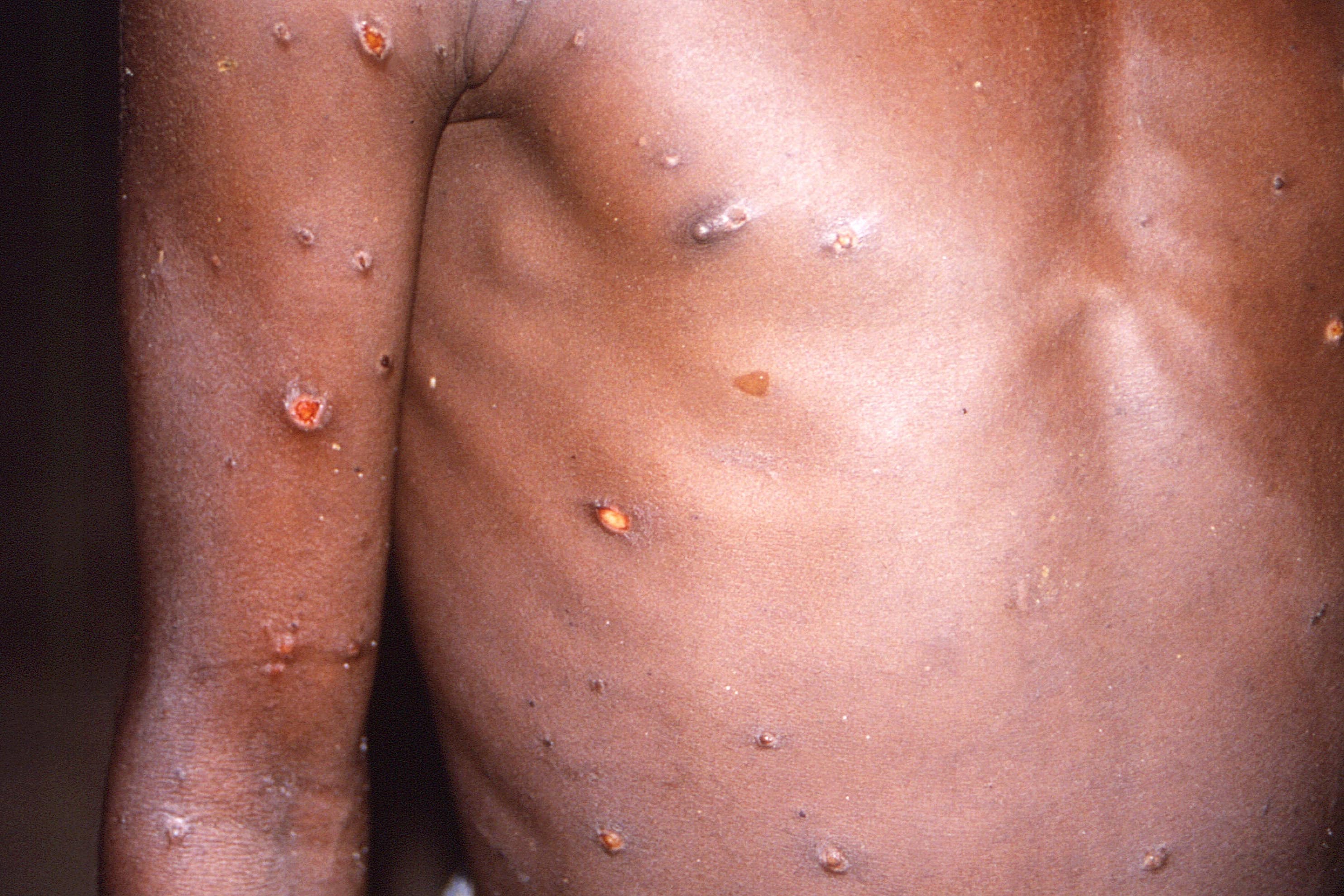 Undated handout file photo of the the arms and torso of a patient who’ s skin displayed a number of lesions due to what had been an active case of mpox.