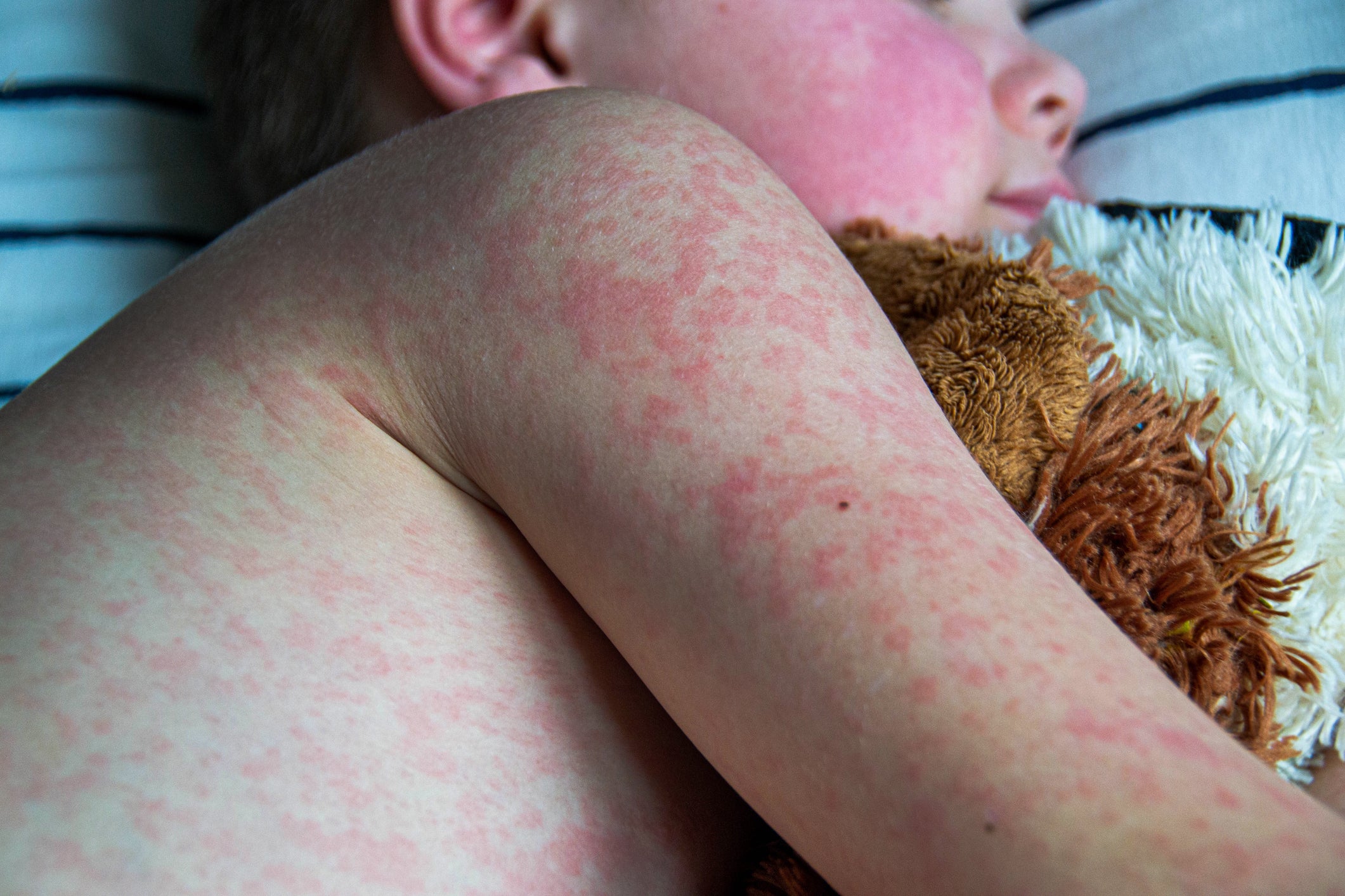 A little boy with measles holds a stuffed animal. Global cases of measles rose by 20 percent from 2022 to 2023, largely due to vaccination gaps in children