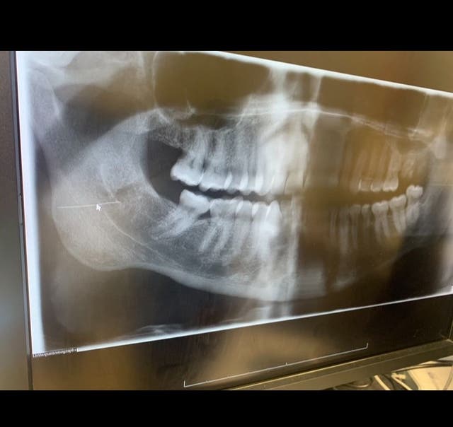 <p>Joe Woollen’s X-ray showing a needle in his mouth
</p>