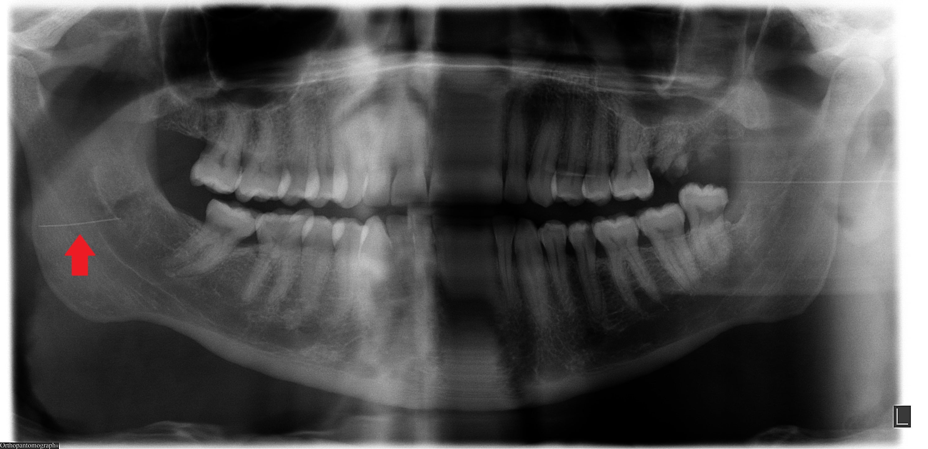 An X-ray showing the needle in the right side of Joe’s face