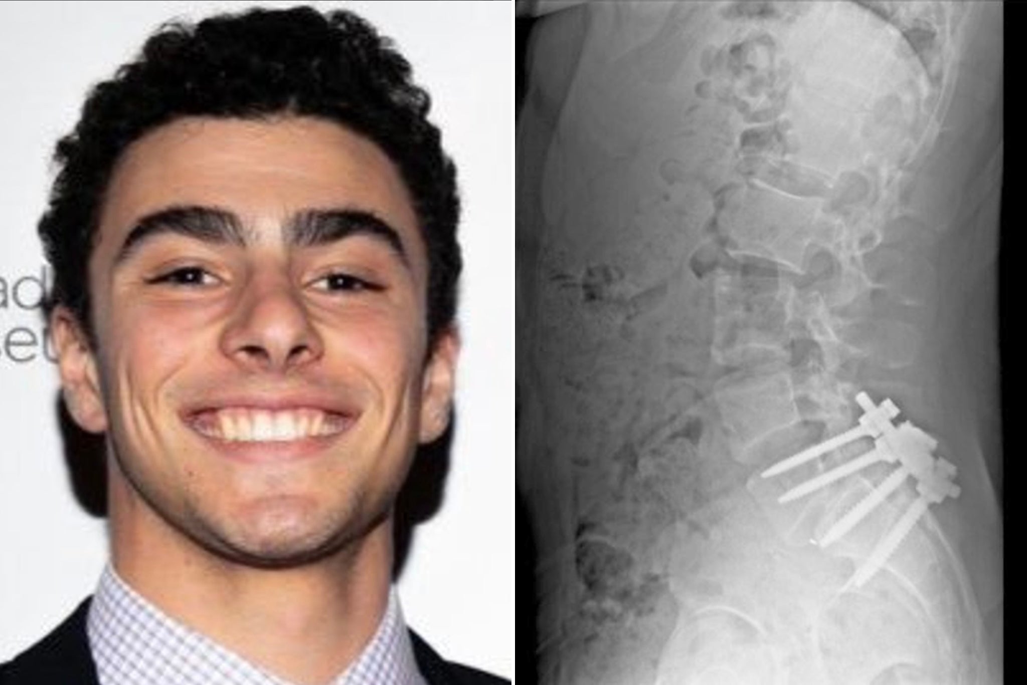 An acquaintance said X-rays of Luigi Mangione’s back “looked heinous, with just giant screws going into his spine.”