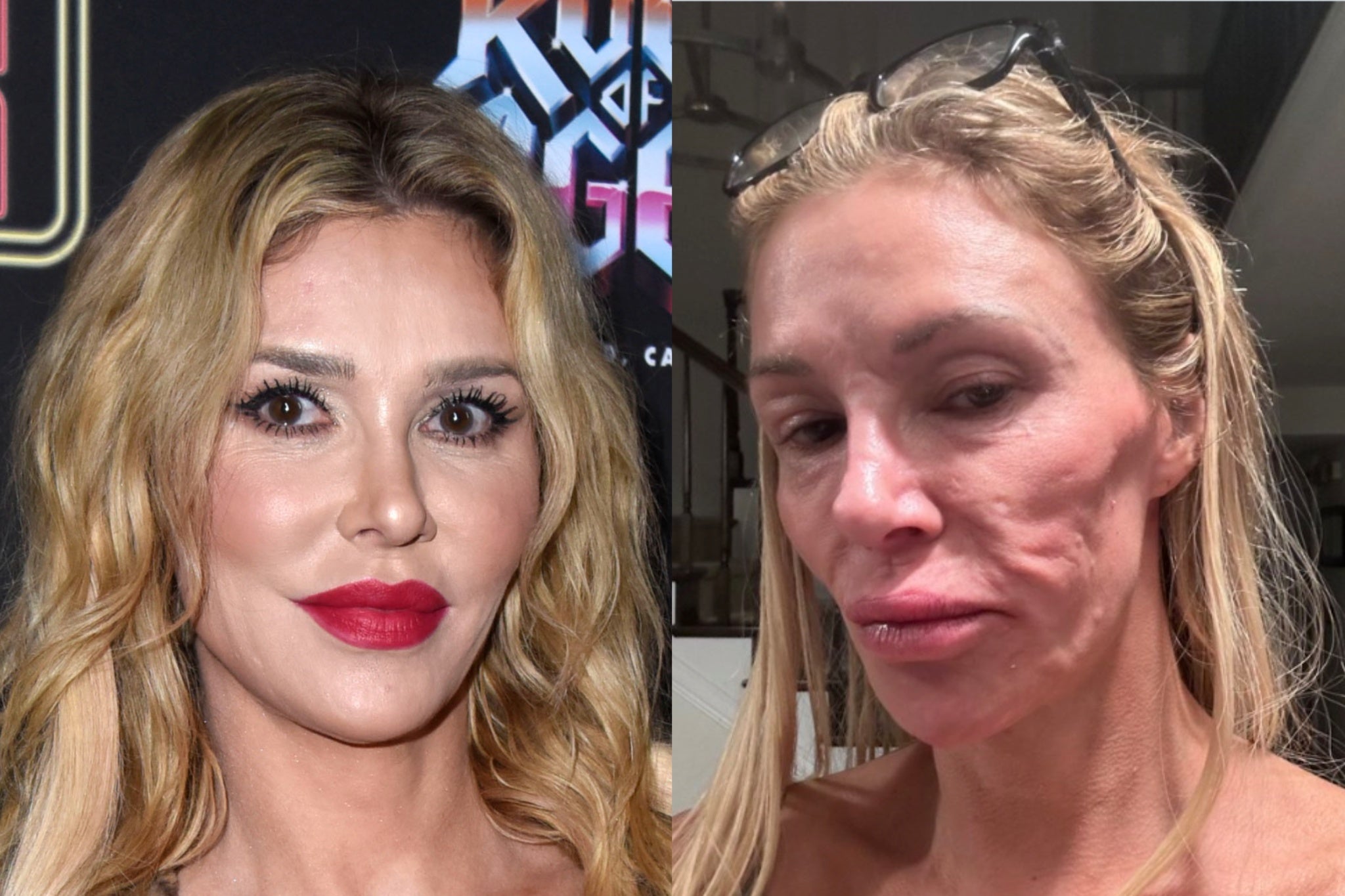 Brandi Glanville says she spent $70,000 trying to treat what doctors initially thought was a parasite in her face
